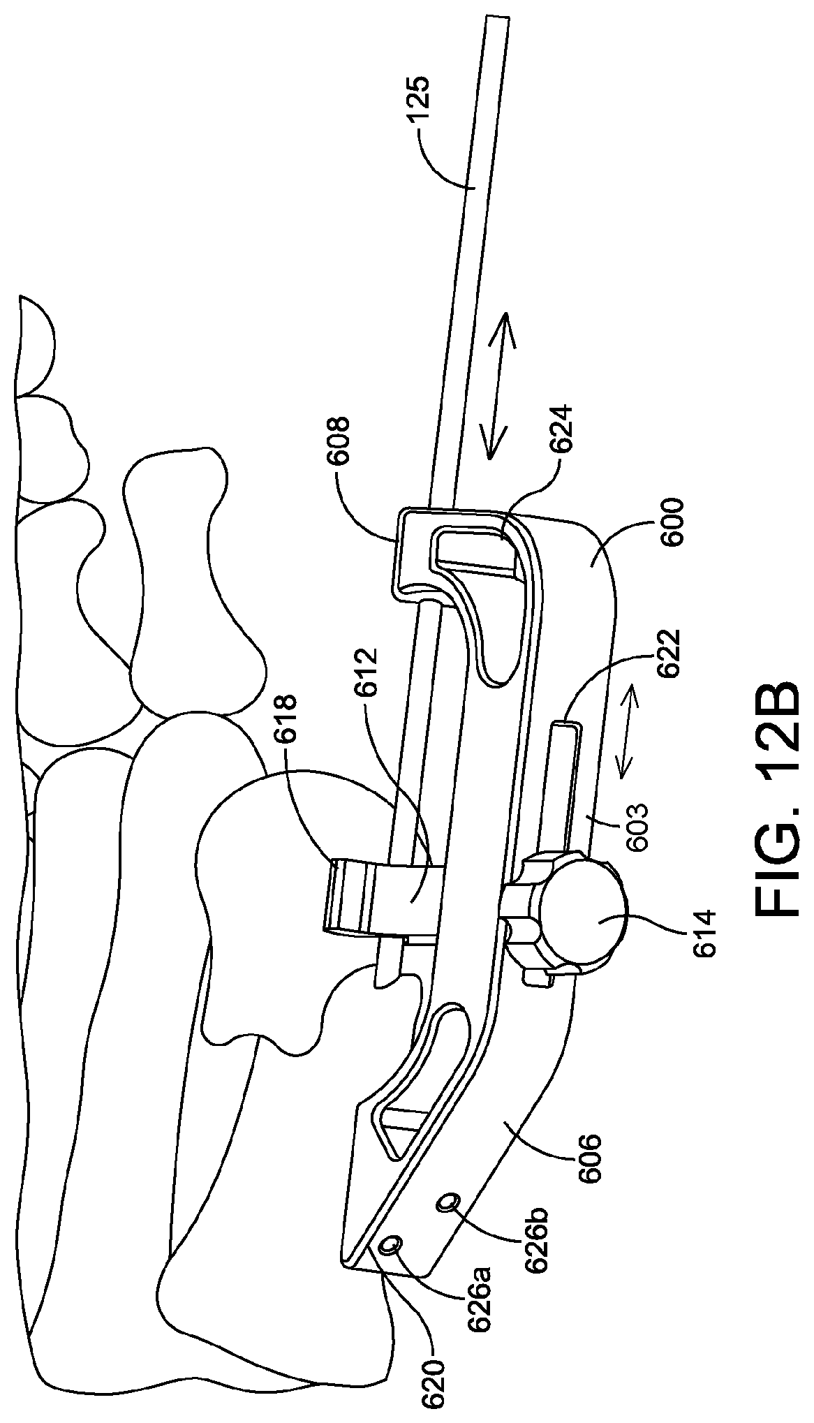 Patent US11779360 Figure 16 – Chevron osteotomy tools and methods