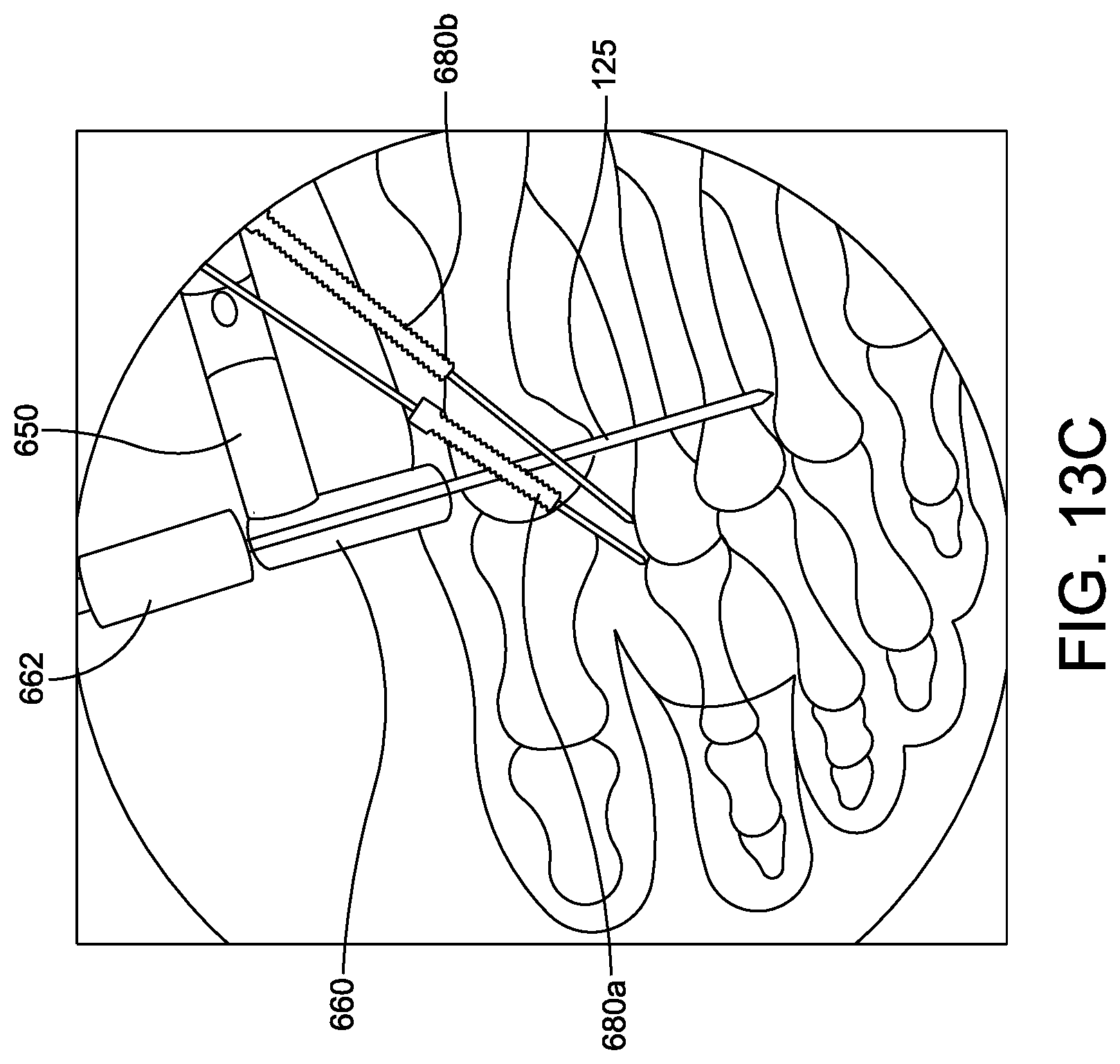 Patent US11779360 Figure 20 – Chevron osteotomy tools and methods