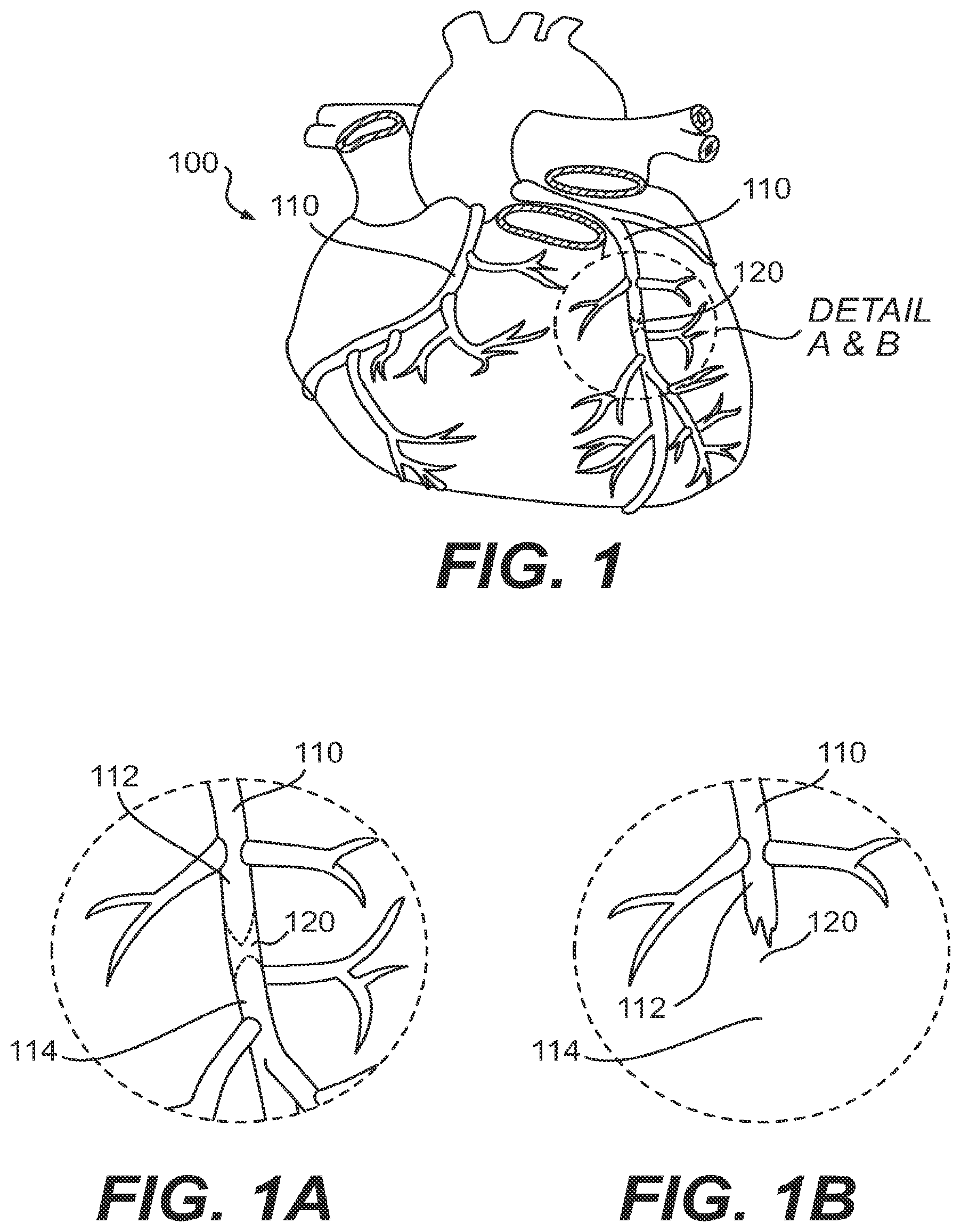 Patent US11779361 Figure 1 – Endovascular devices and methods for exploiting intramural space