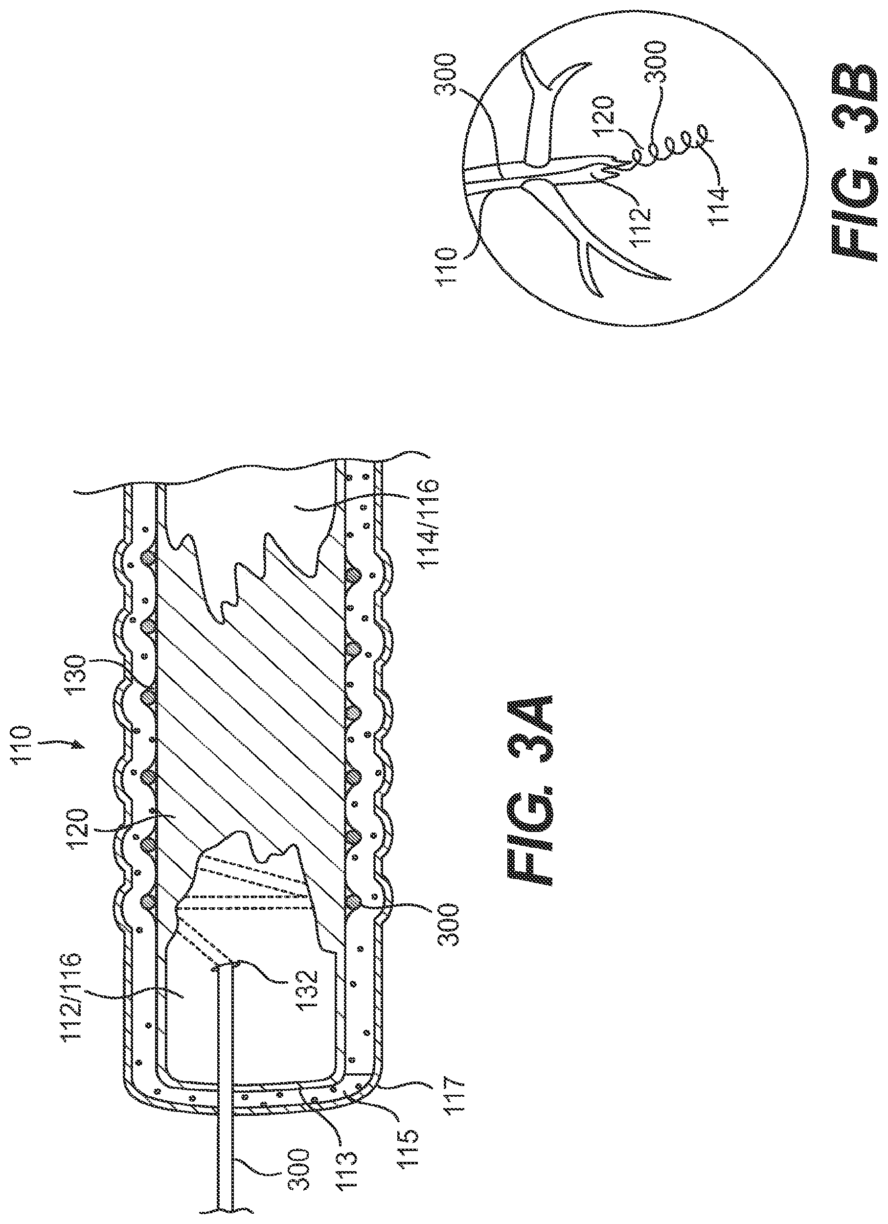 Patent US11779361 Figure 3 – Endovascular devices and methods for exploiting intramural space