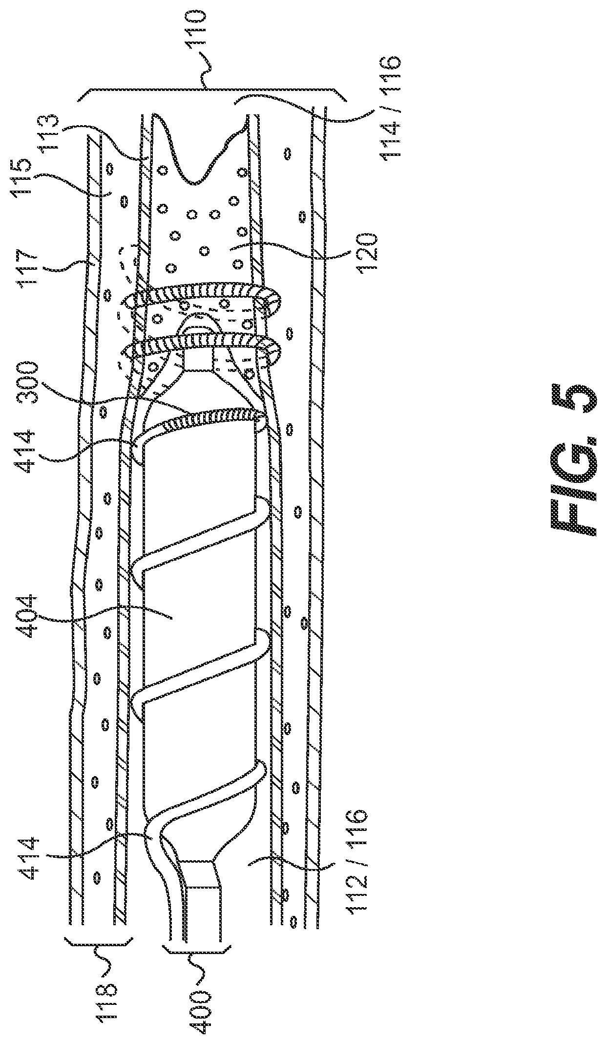 Patent US11779361 Figure 5 – Endovascular devices and methods for exploiting intramural space