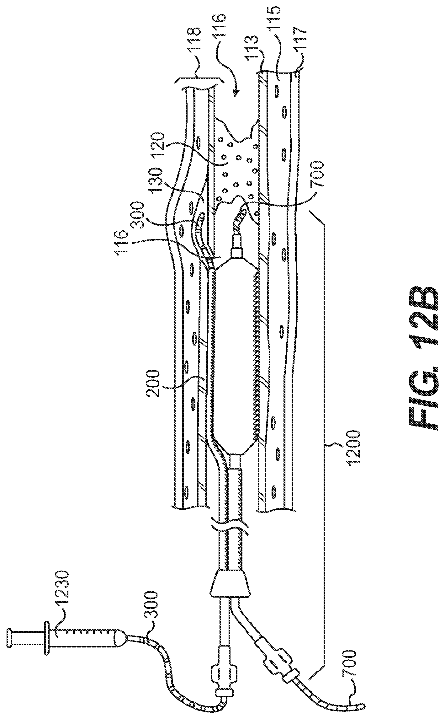 Patent US11779361 Figure 16 – Endovascular devices and methods for exploiting intramural space