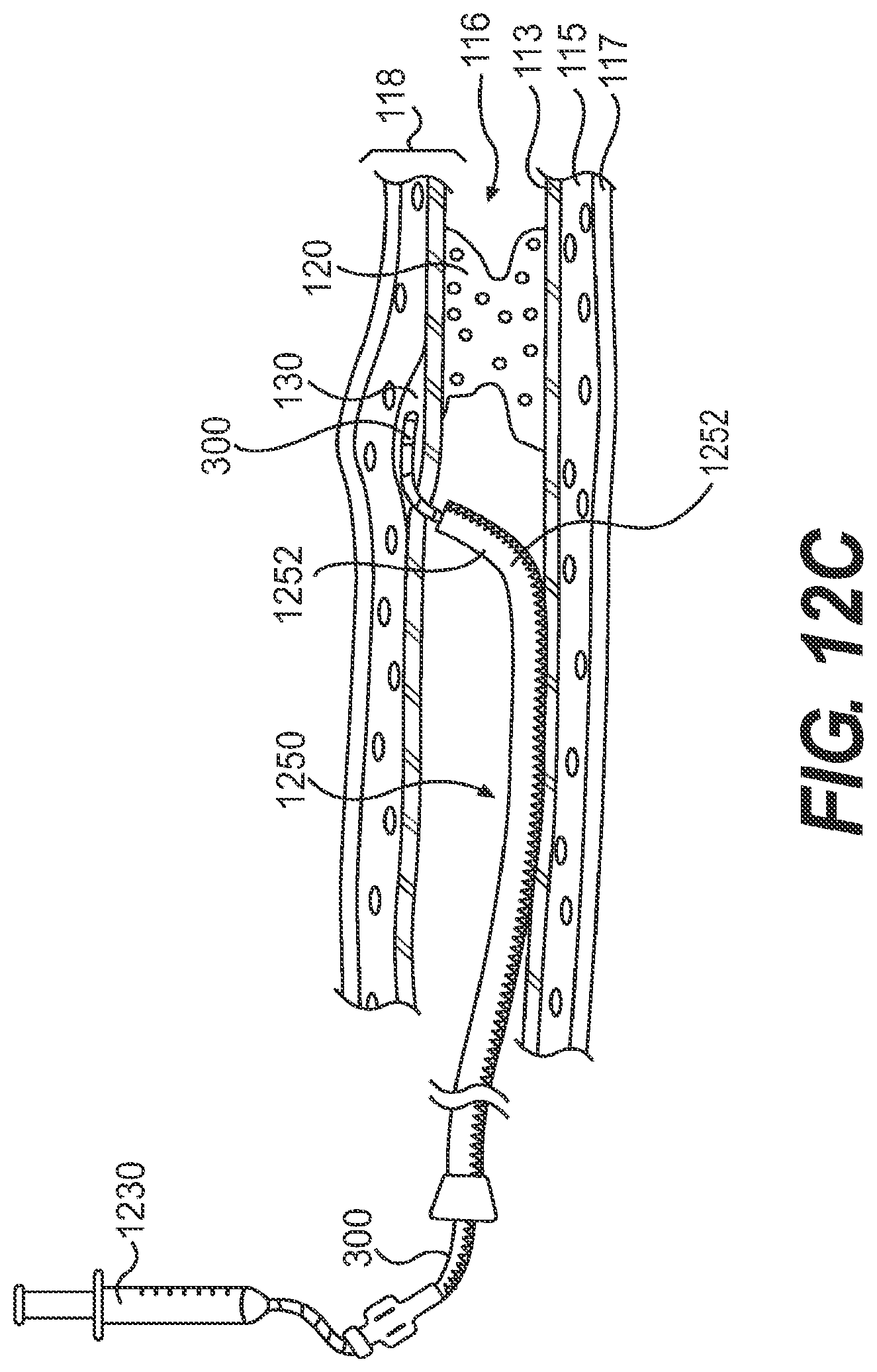 Patent US11779361 Figure 17 – Endovascular devices and methods for exploiting intramural space
