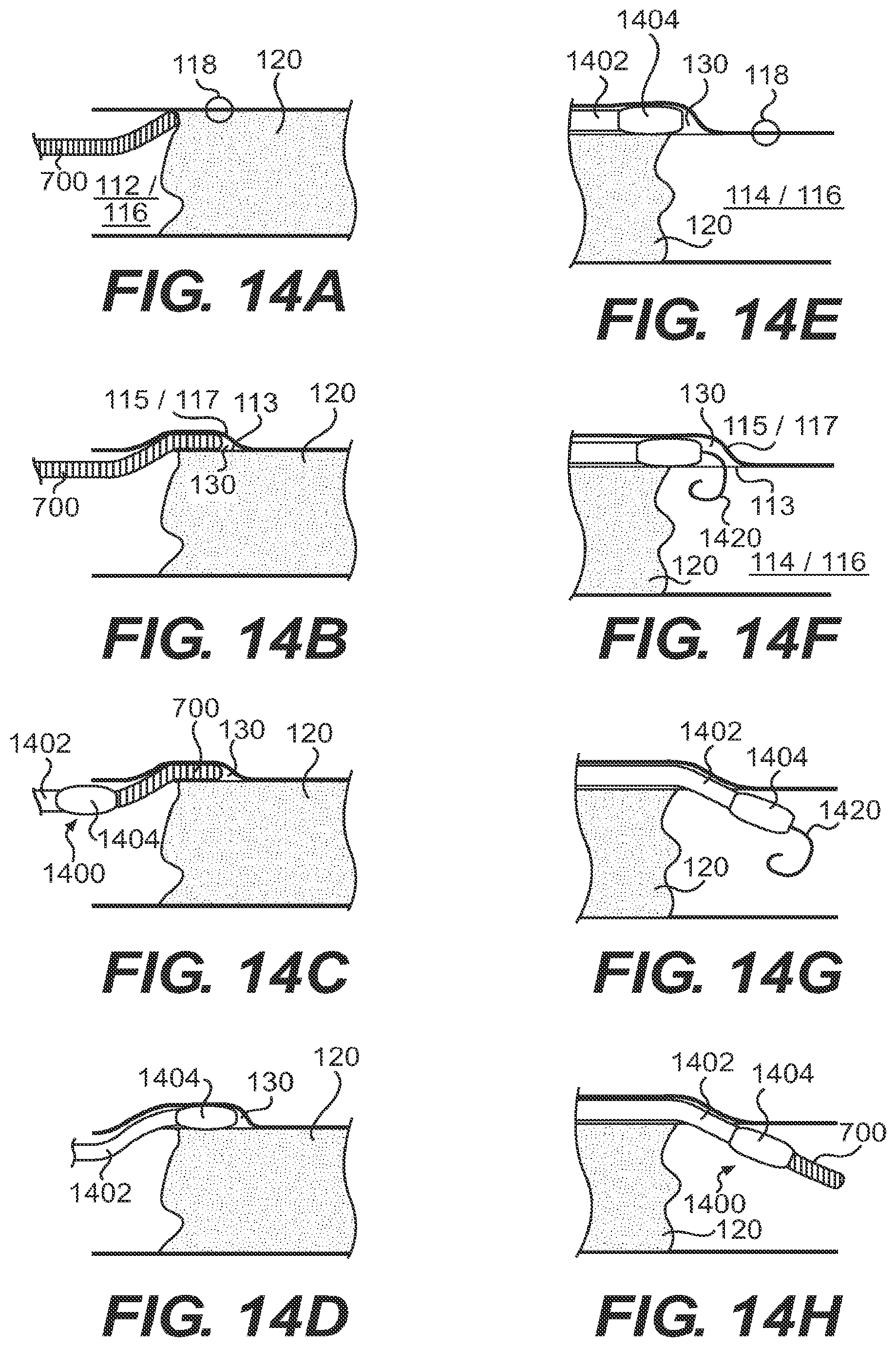 Patent US11779361 Figure 19 – Endovascular devices and methods for exploiting intramural space