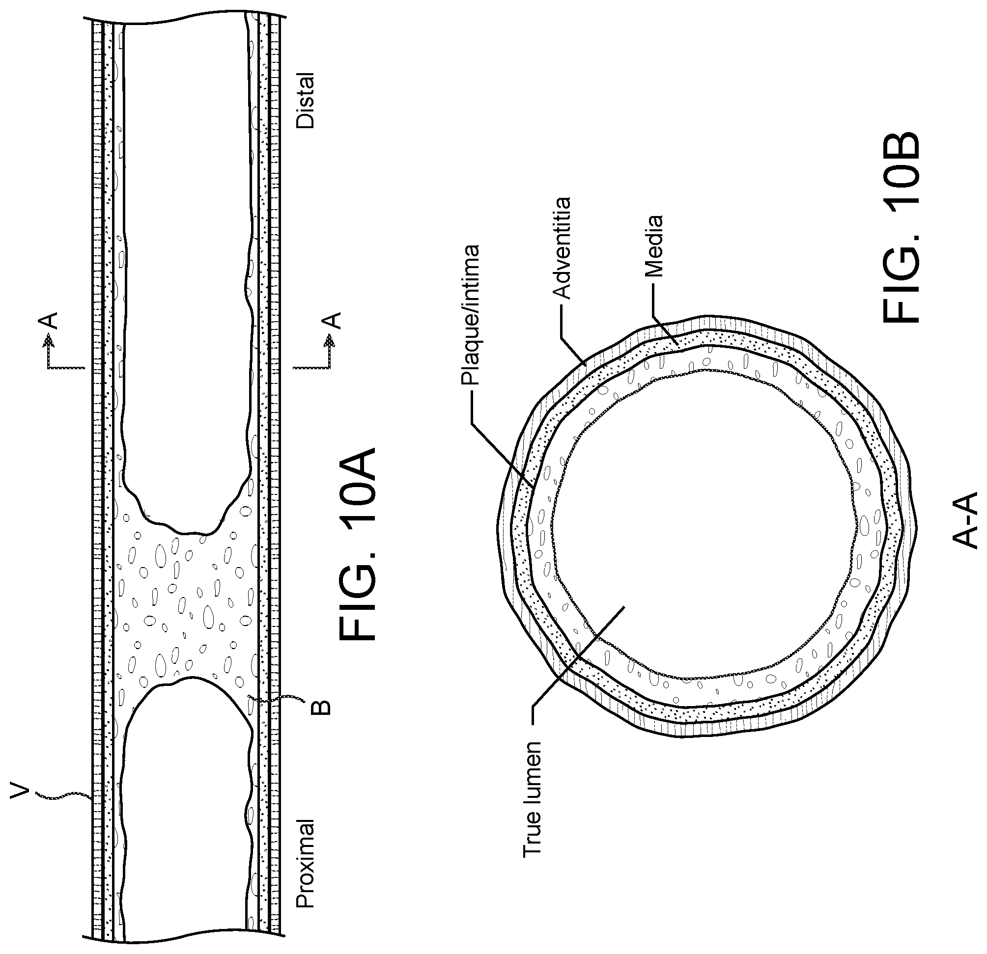 Patent US11779362 Figure 10 – Methods and apparatus for true lumen re-entry