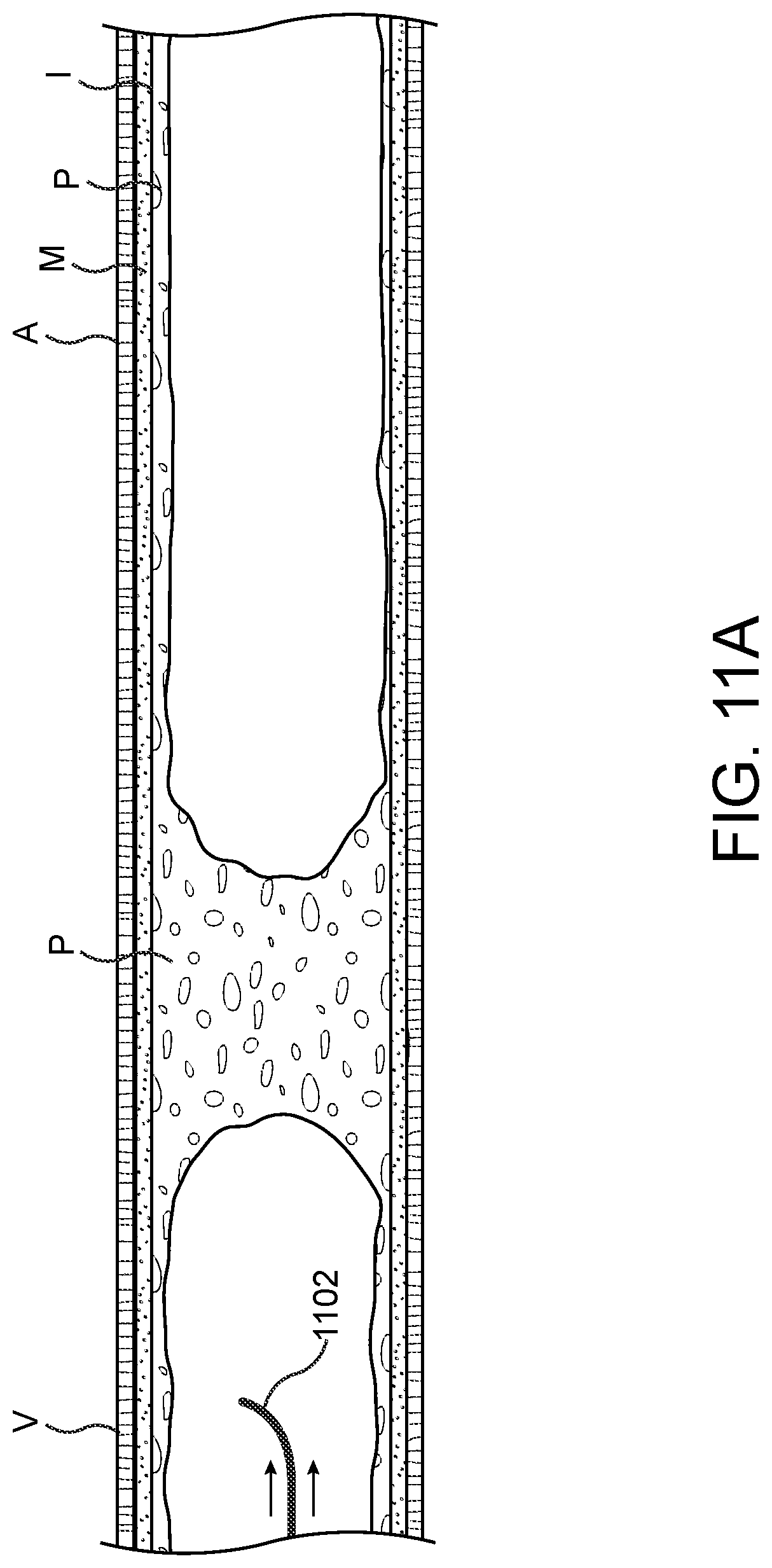 Patent US11779362 Figure 11 – Methods and apparatus for true lumen re-entry
