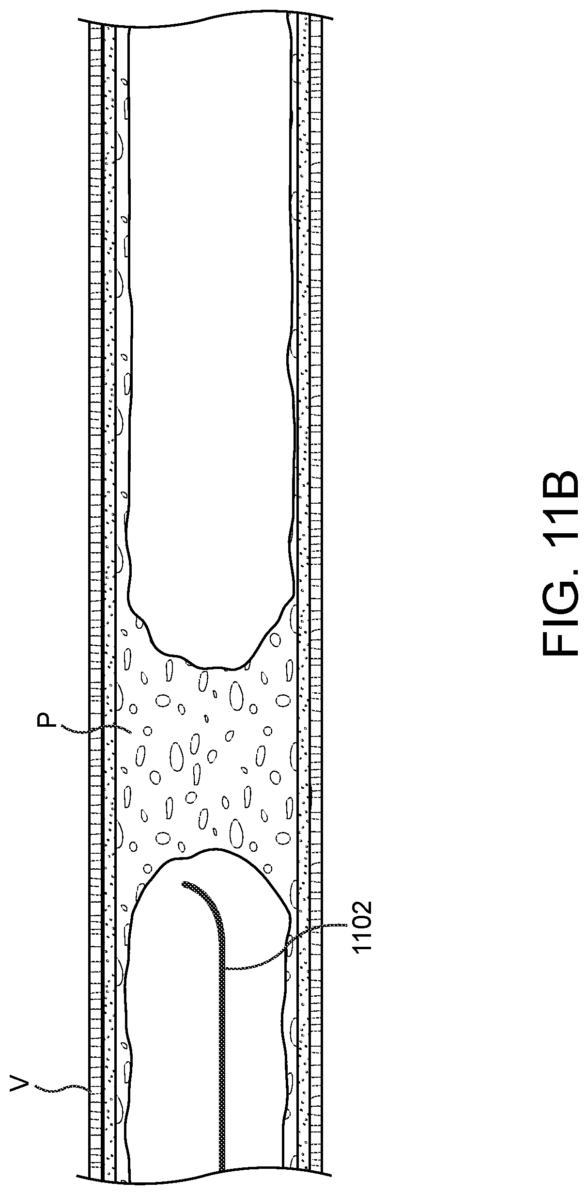 Patent US11779362 Figure 12 – Methods and apparatus for true lumen re-entry