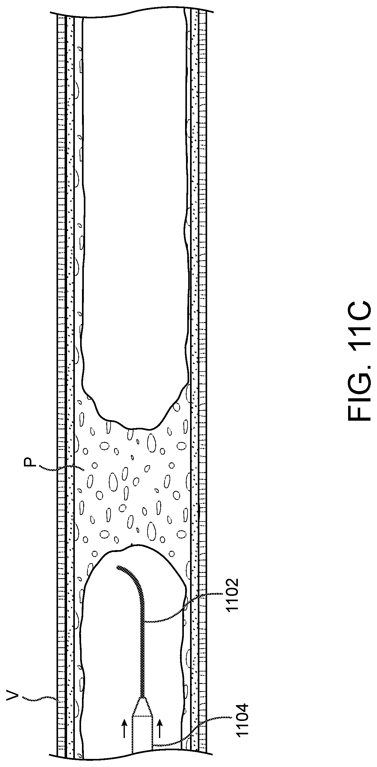 Patent US11779362 Figure 13 – Methods and apparatus for true lumen re-entry