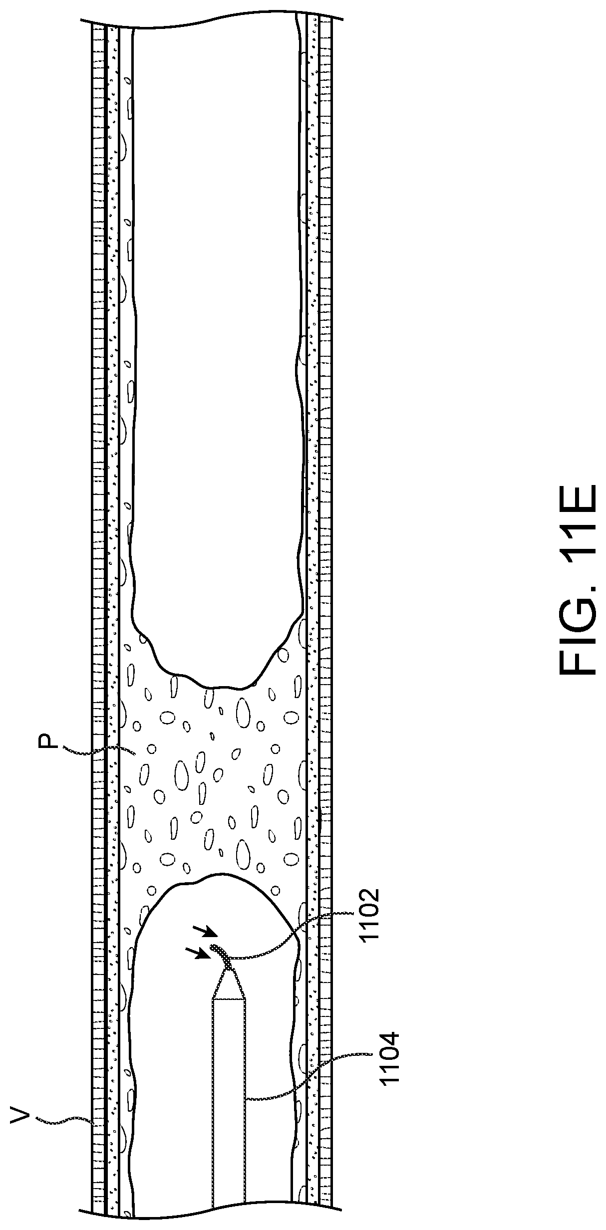 Patent US11779362 Figure 15 – Methods and apparatus for true lumen re-entry