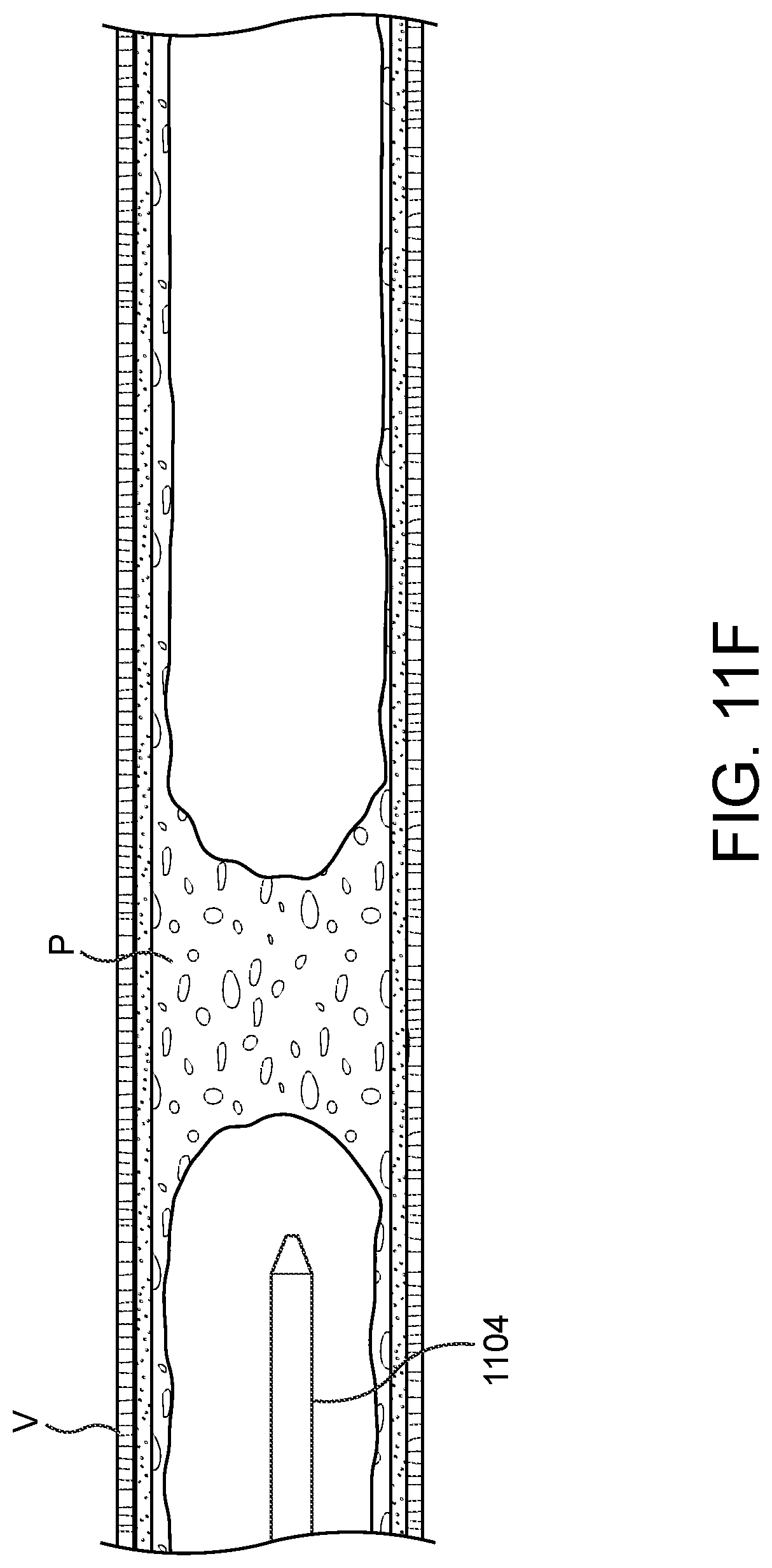 Patent US11779362 Figure 16 – Methods and apparatus for true lumen re-entry