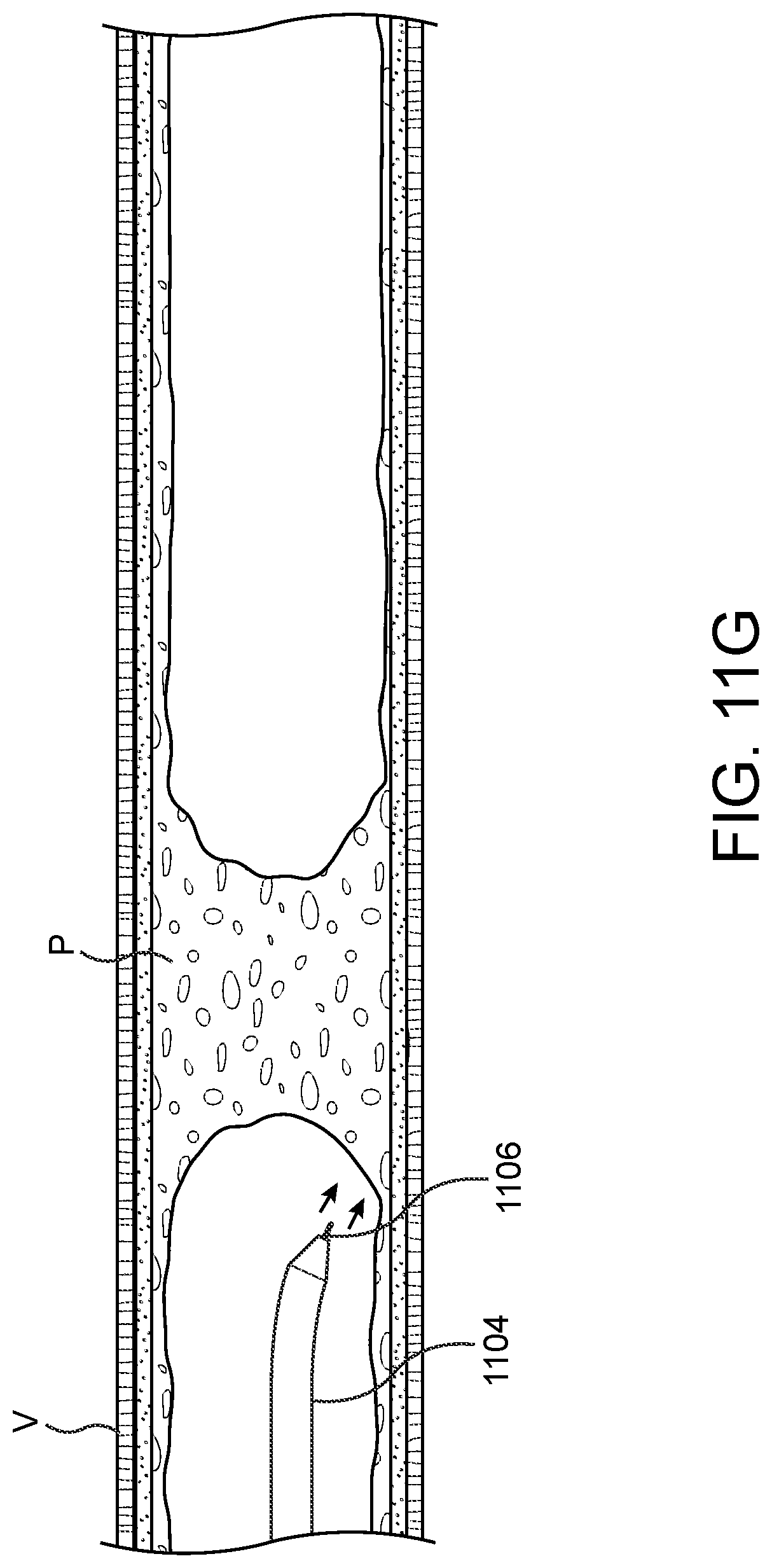 Patent US11779362 Figure 17 – Methods and apparatus for true lumen re-entry