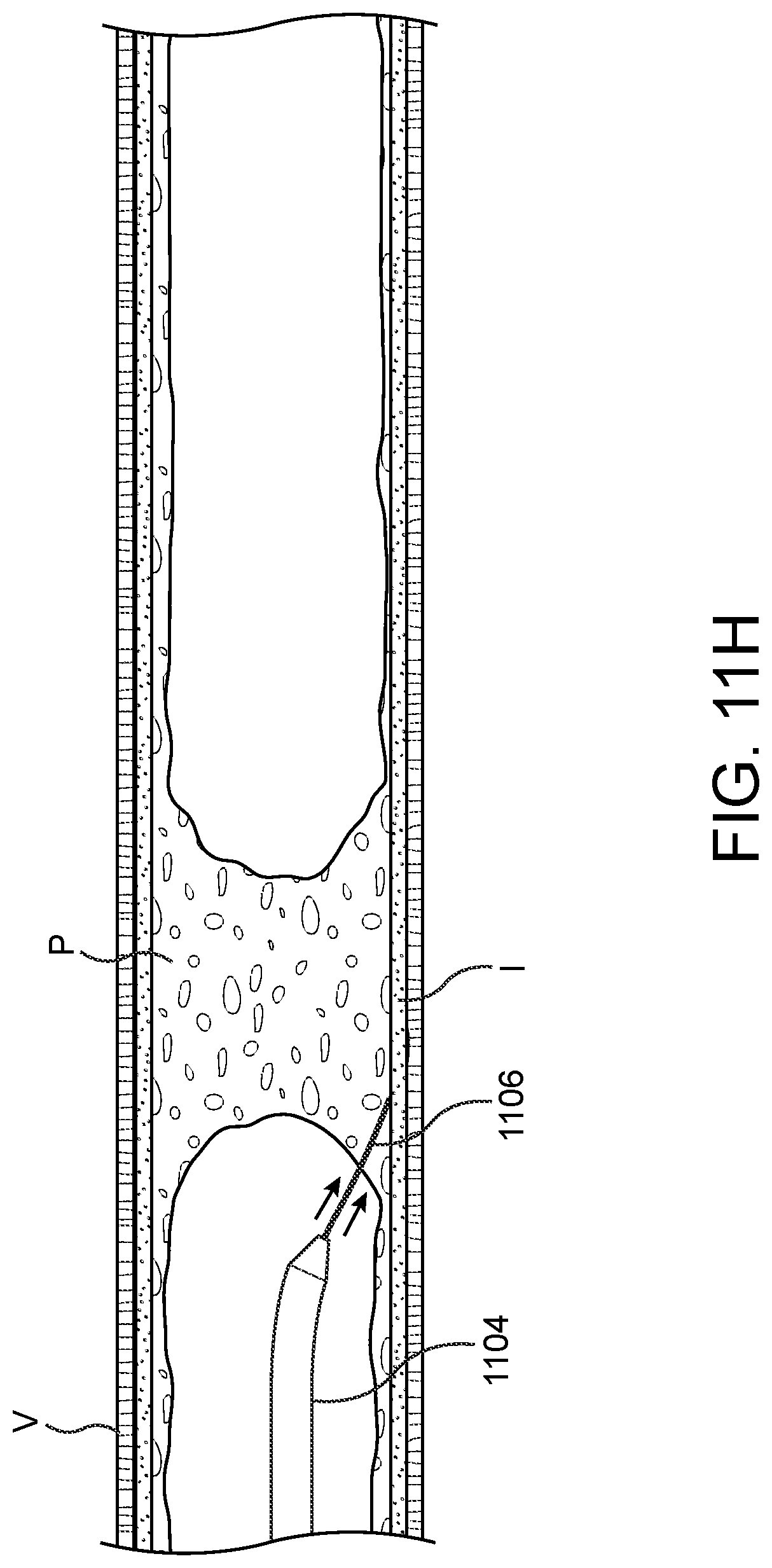 Patent US11779362 Figure 18 – Methods and apparatus for true lumen re-entry