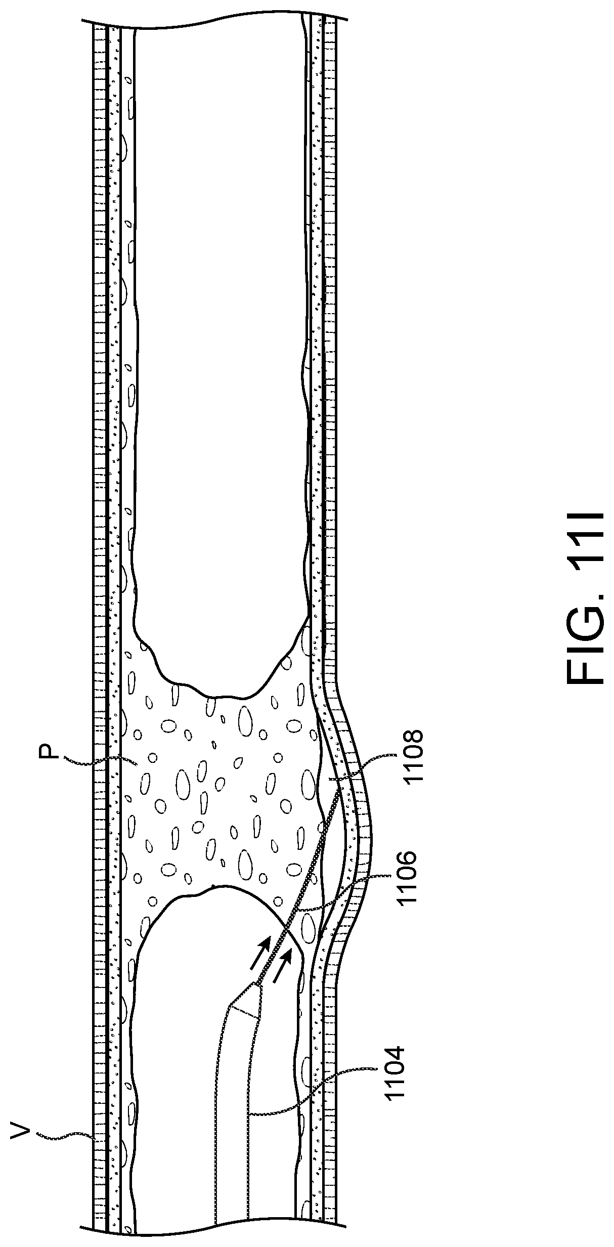 Patent US11779362 Figure 19 – Methods and apparatus for true lumen re-entry