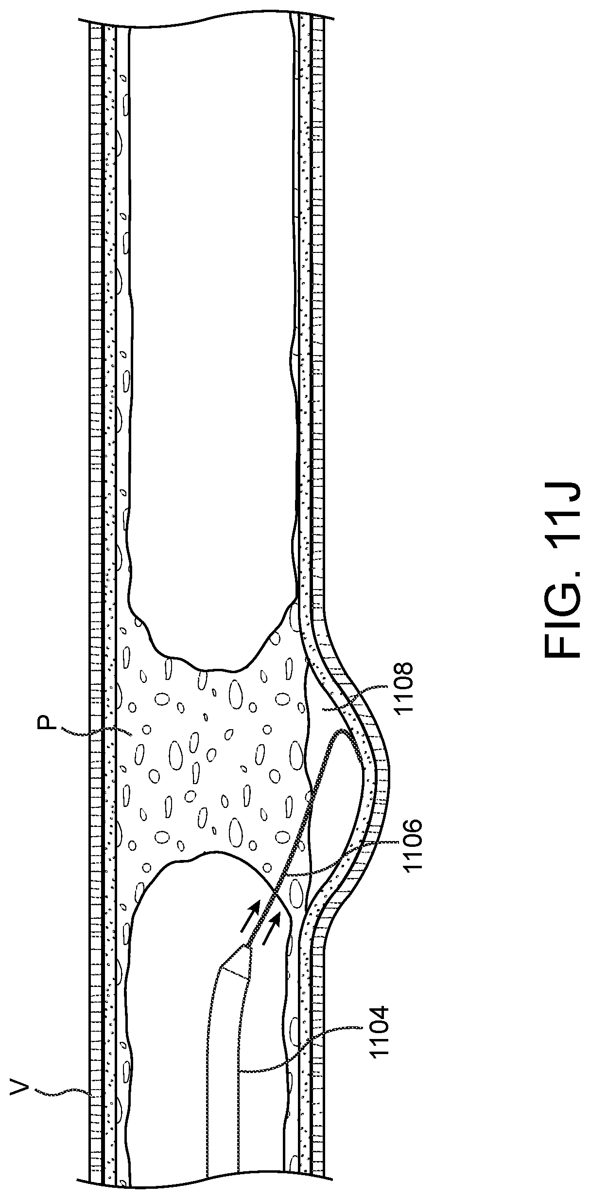 Patent US11779362 Figure 20 – Methods and apparatus for true lumen re-entry