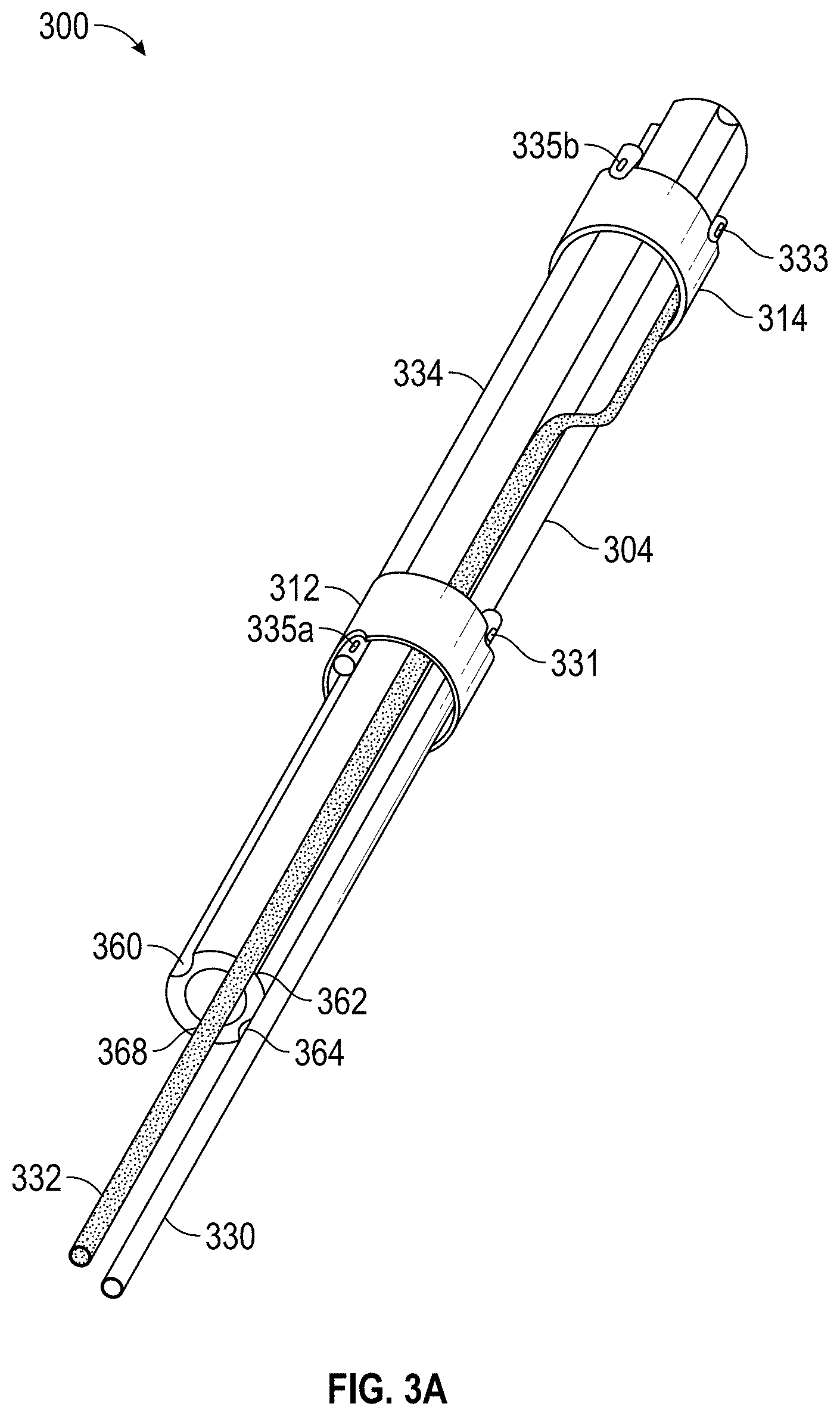Patent US11779363 Figure 3 – Intravascular lithotripsy catheter with interfering shock waves