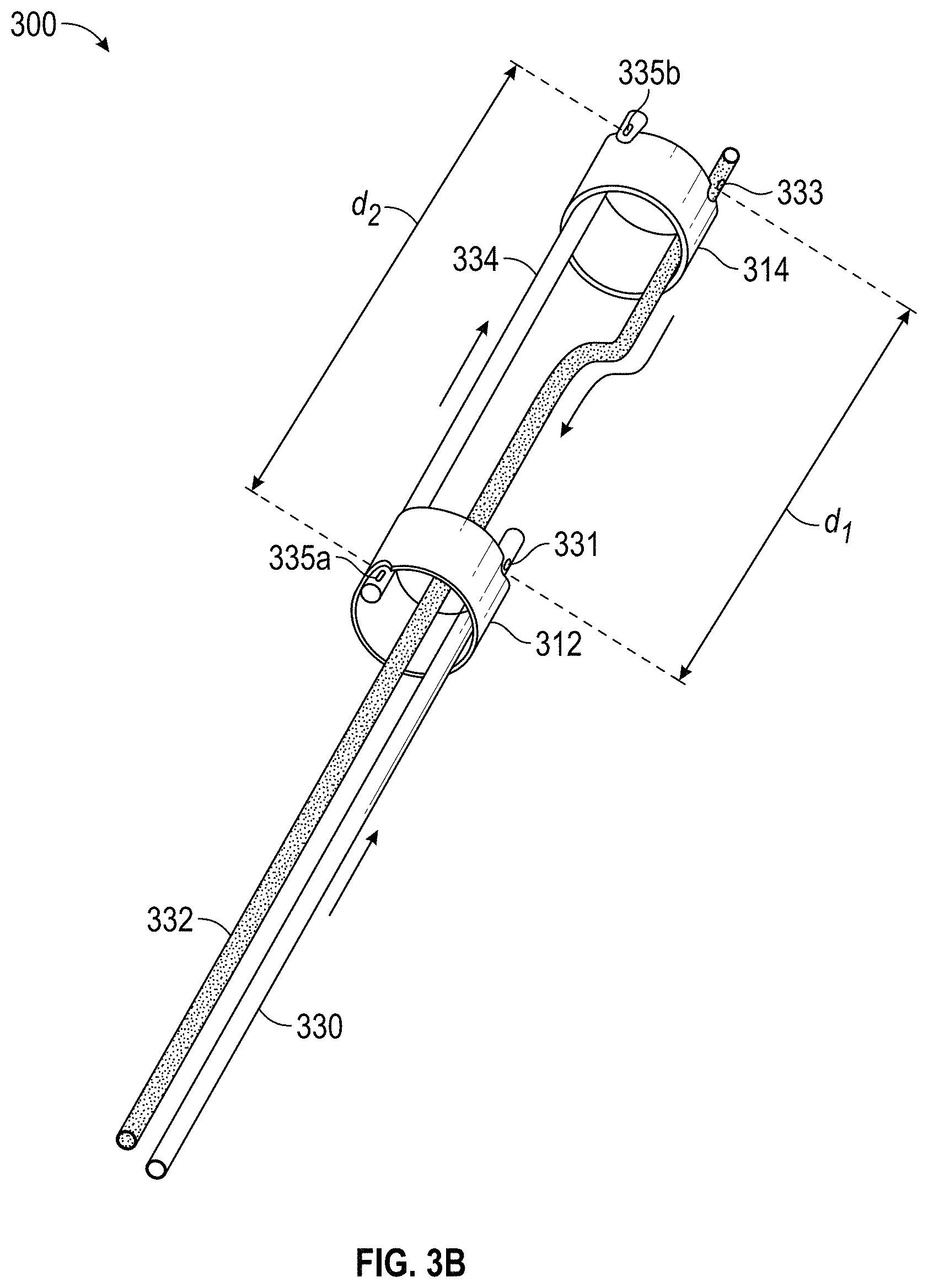 Patent US11779363 Figure 4 – Intravascular lithotripsy catheter with interfering shock waves