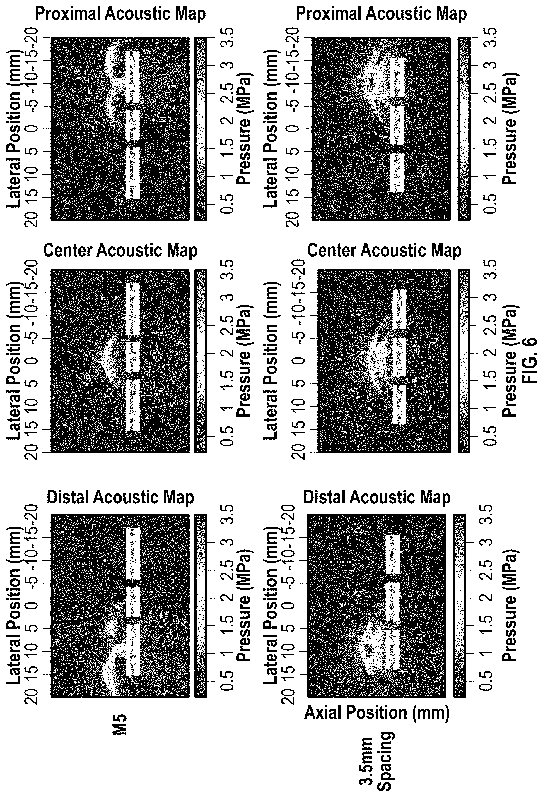 Patent US11779363 Figure 8 – Intravascular lithotripsy catheter with interfering shock waves