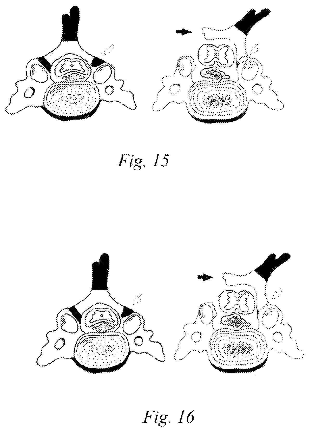 Patent US11779366 Figure 8 – Ultrasonic osteotome bit