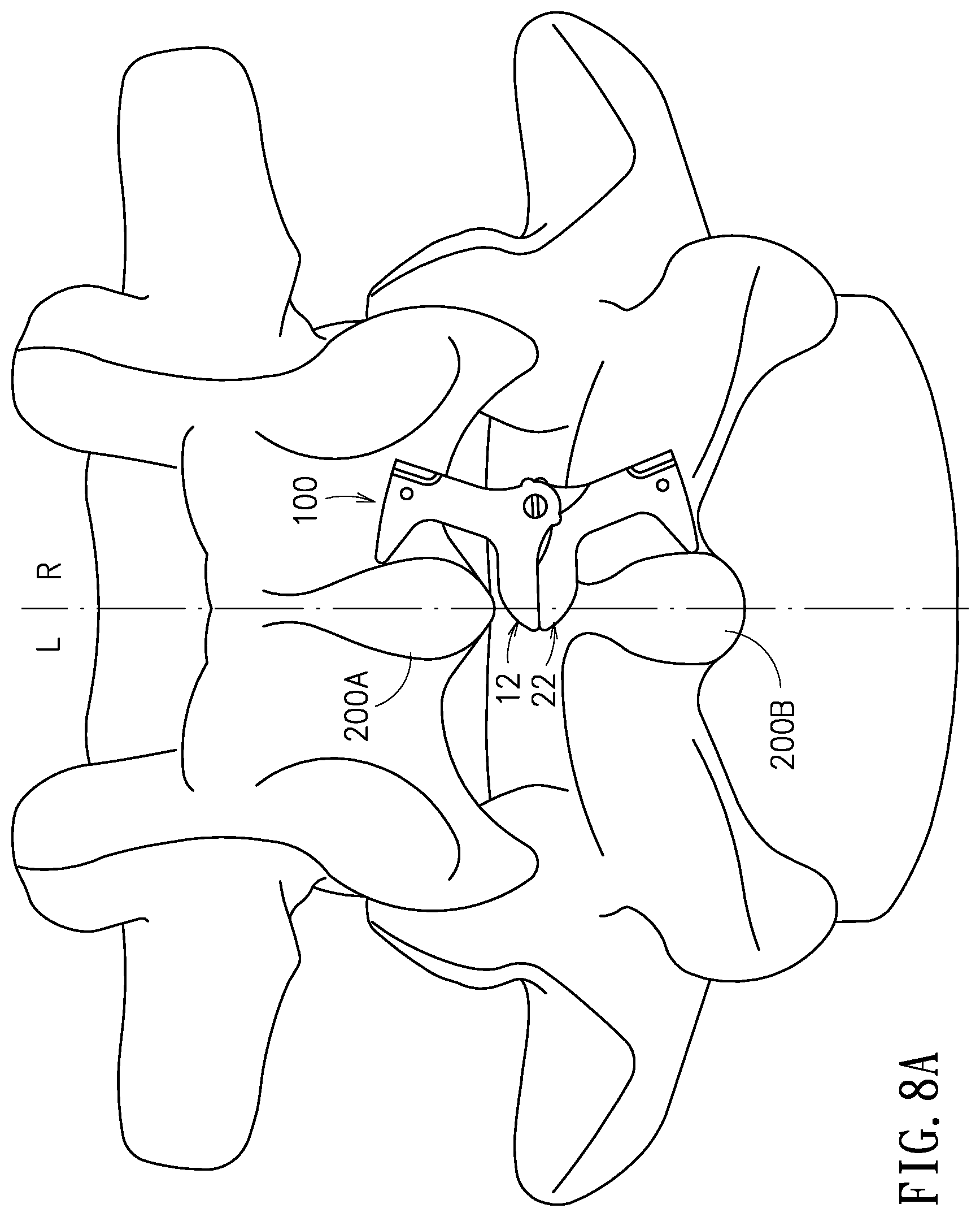 Patent US11779375 Figure 8 – Device and method for expanding spacing between spinous processes