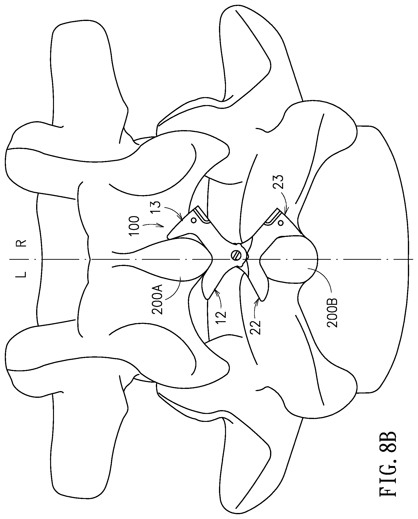 Patent US11779375 Figure 9 – Device and method for expanding spacing between spinous processes