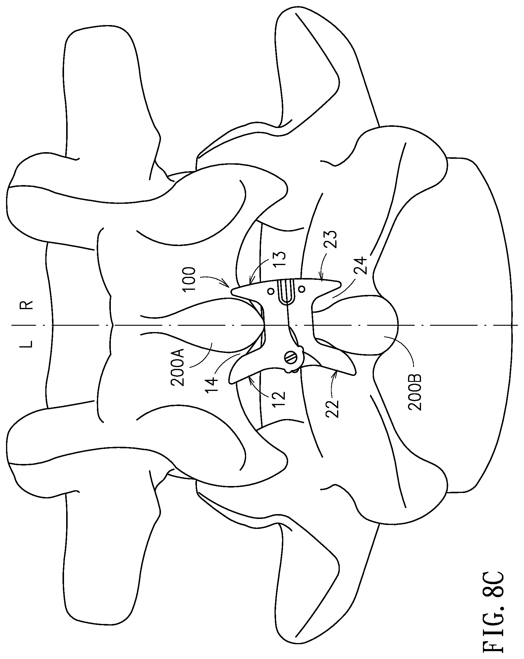 Patent US11779375 Figure 10 – Device and method for expanding spacing between spinous processes
