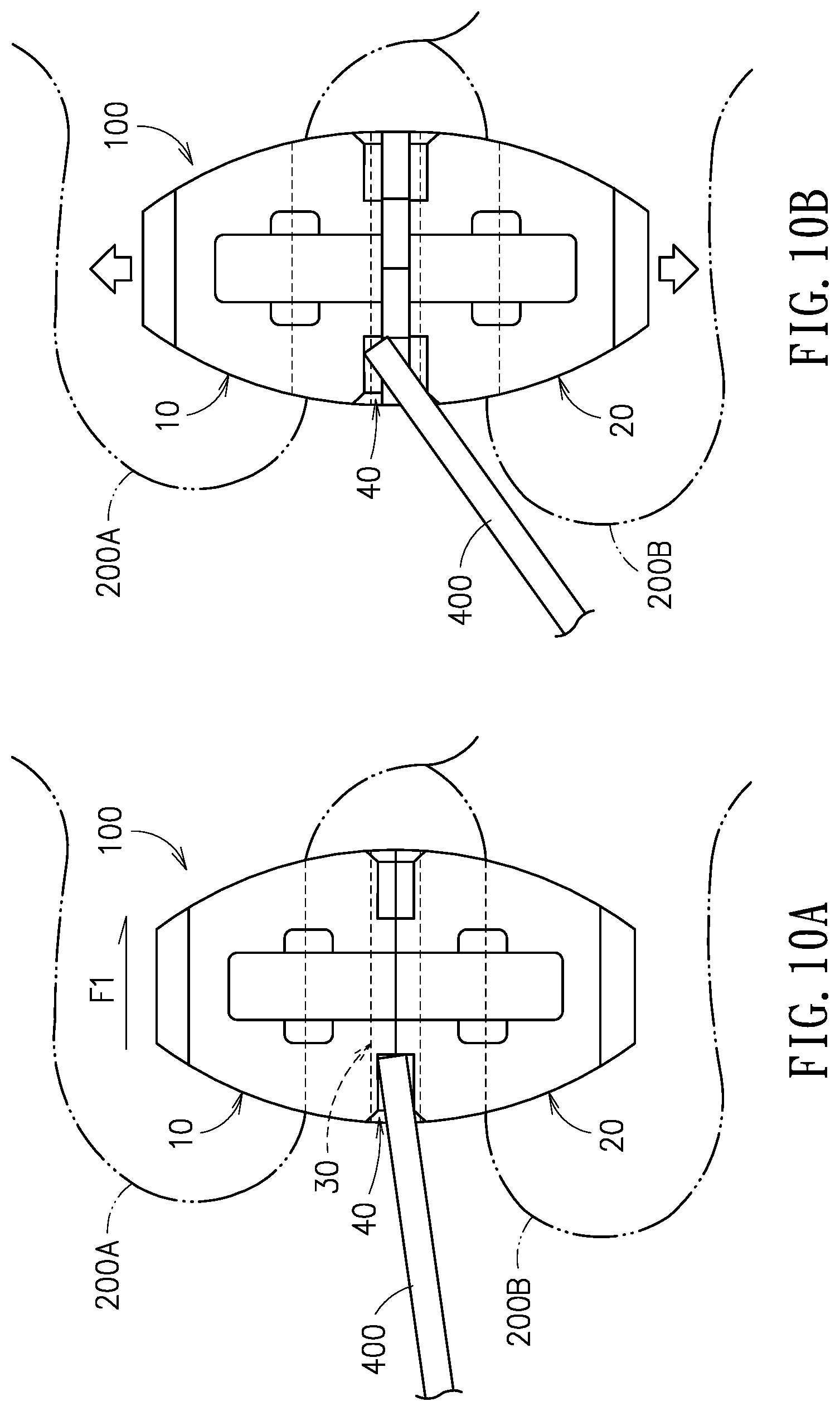 Patent US11779375 Figure 12 – Device and method for expanding spacing between spinous processes