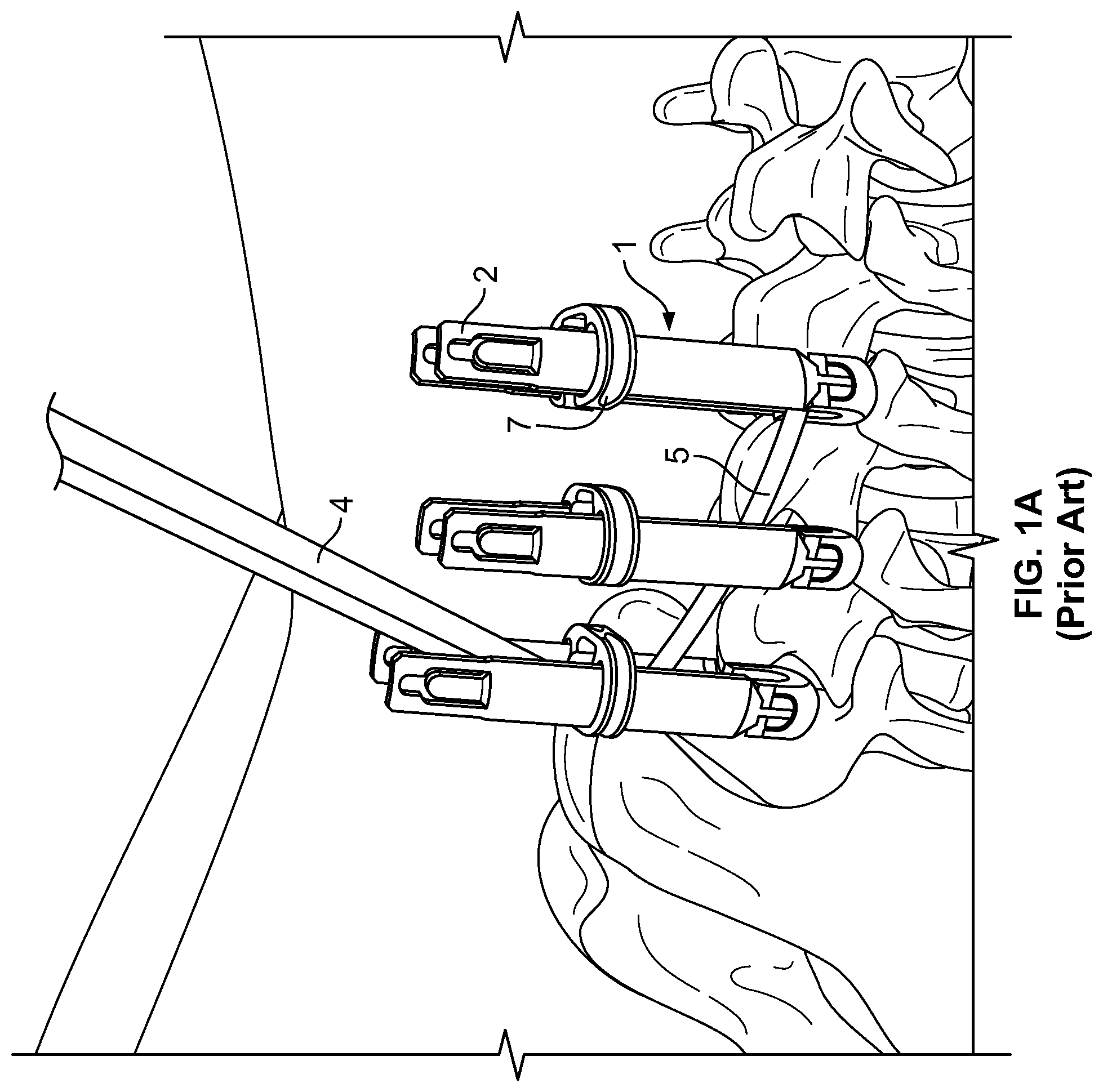 Patent US11779377 Figure 1 – Systems and methods for percutaneous spinal fusion