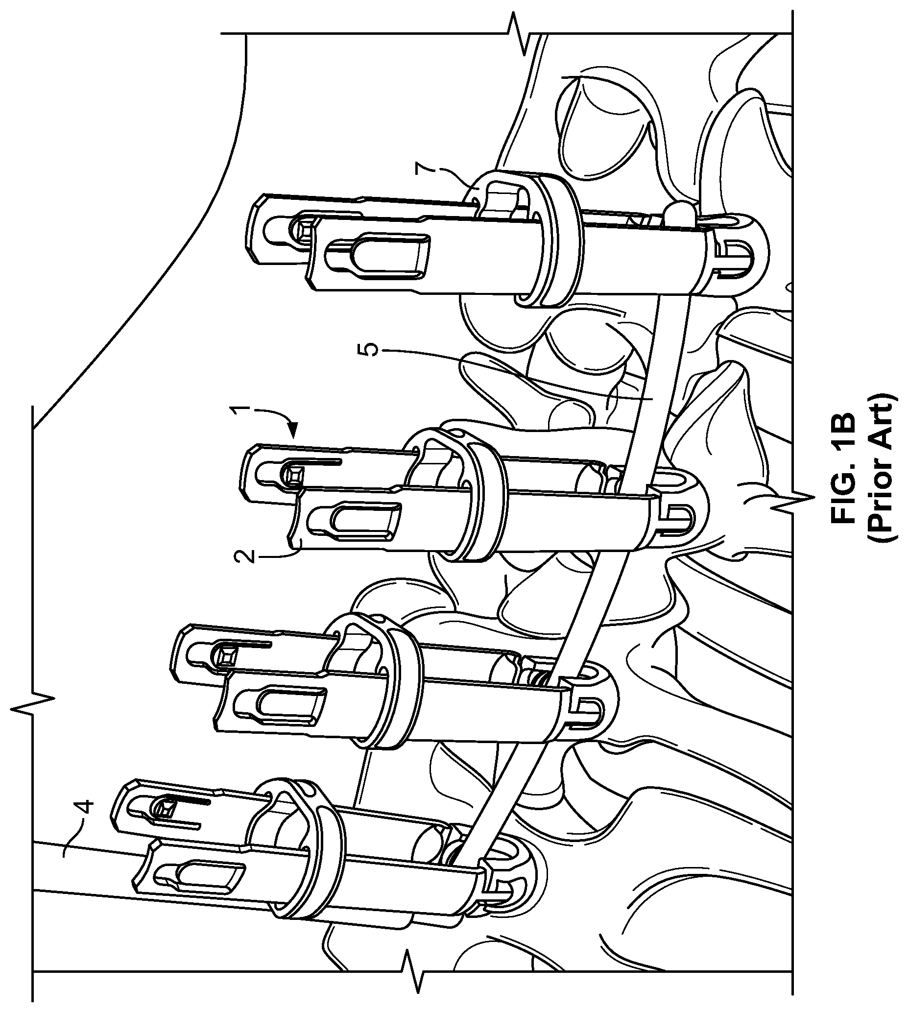 Patent US11779377 Figure 2 – Systems and methods for percutaneous spinal fusion
