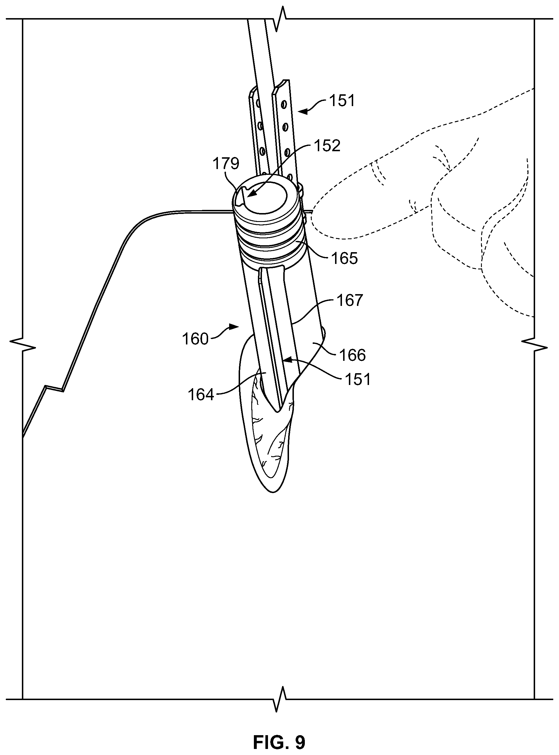 Patent US11779377 Figure 9 – Systems and methods for percutaneous spinal fusion