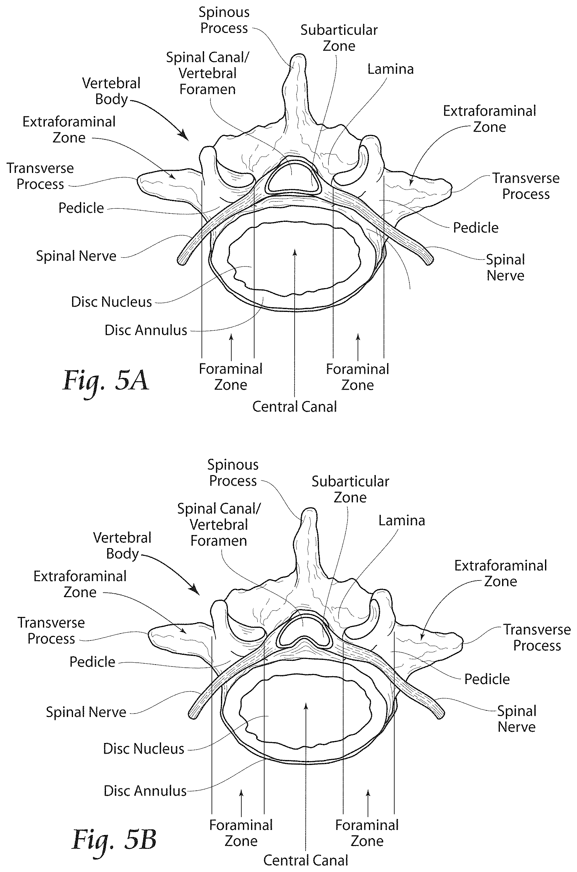 Patent US11779380 Figure 4 – Methods, systems, and devices for the treatment of stenosis