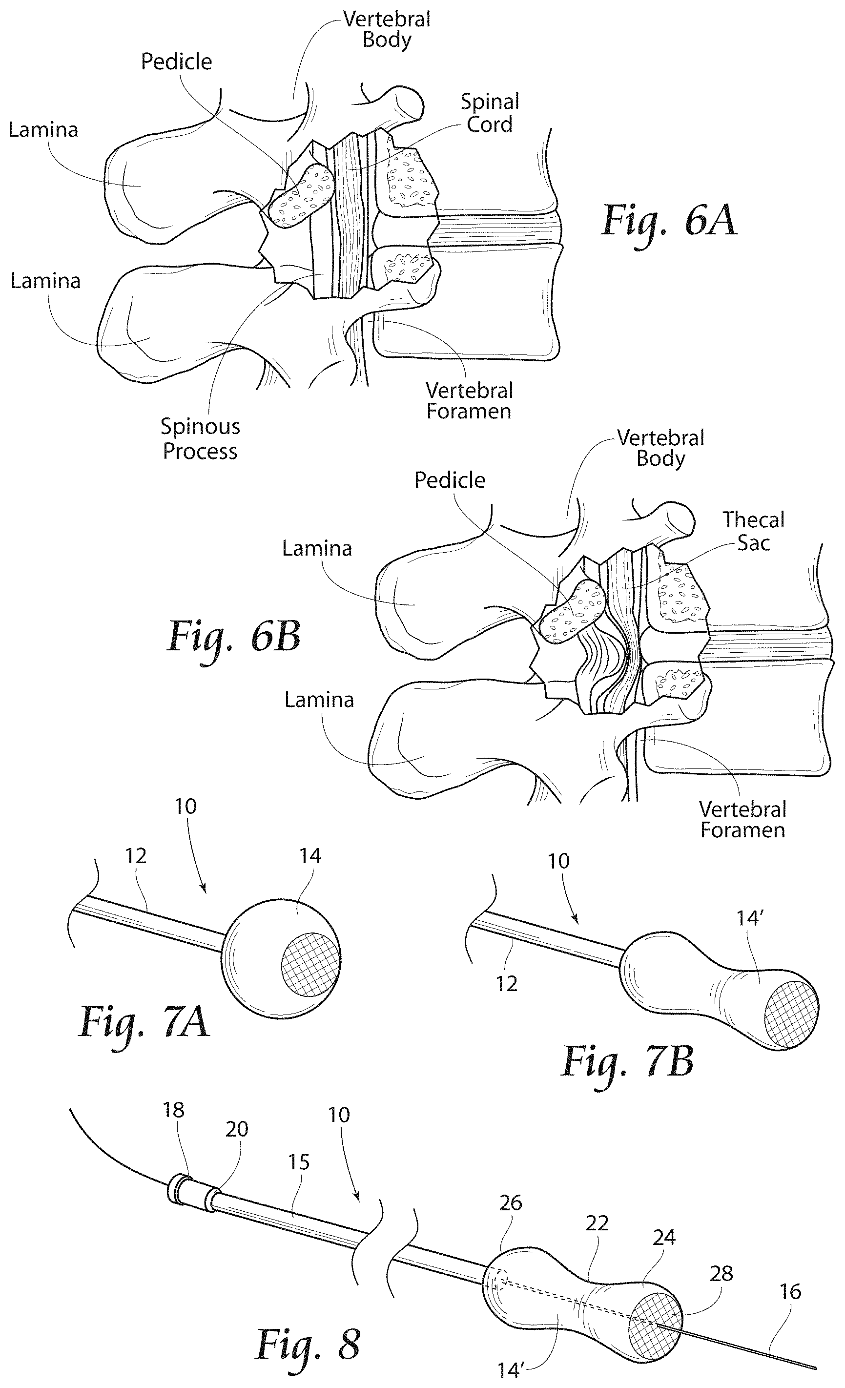 Patent US11779380 Figure 5 – Methods, systems, and devices for the treatment of stenosis