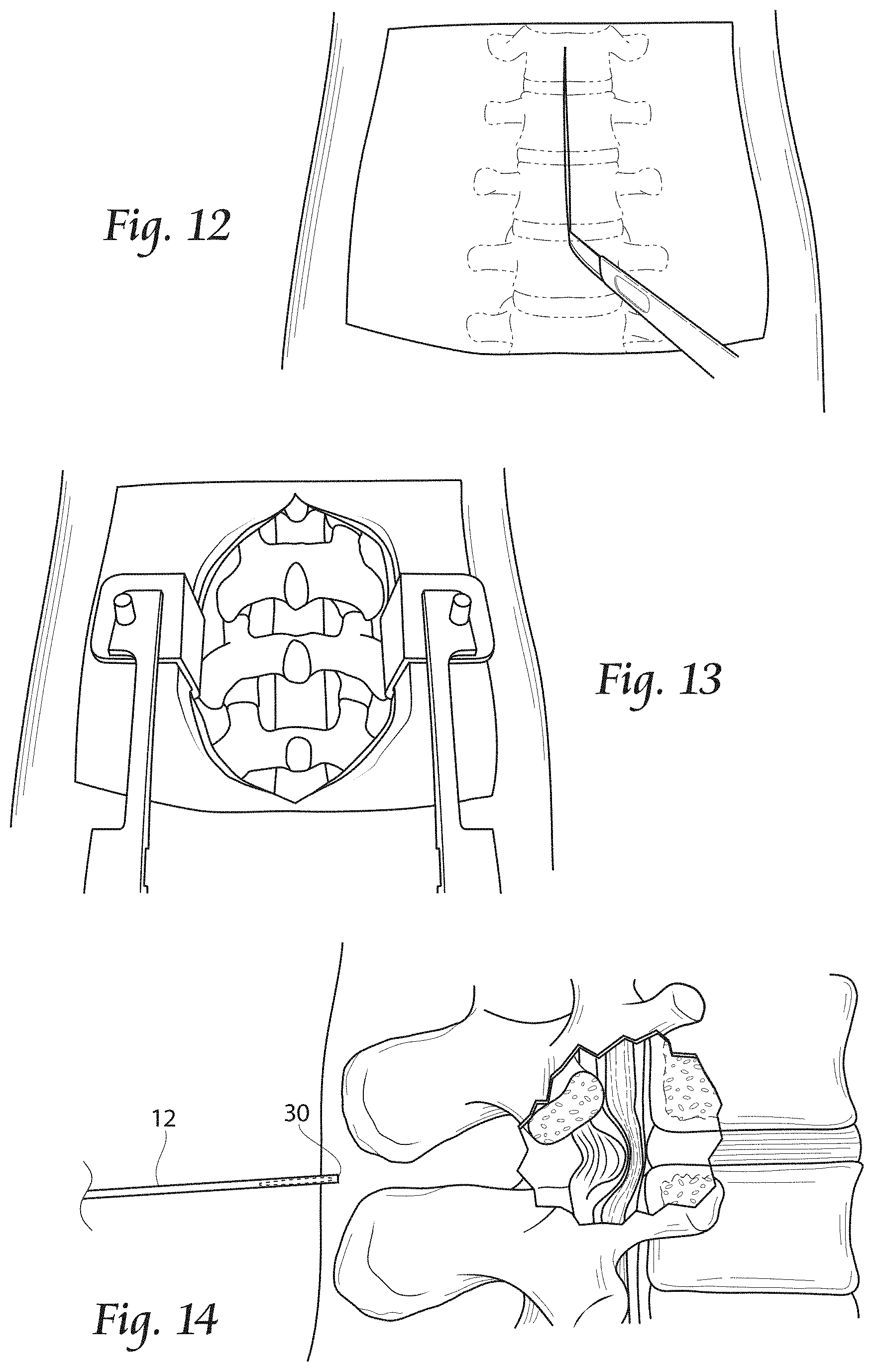 Patent US11779380 Figure 7 – Methods, systems, and devices for the treatment of stenosis