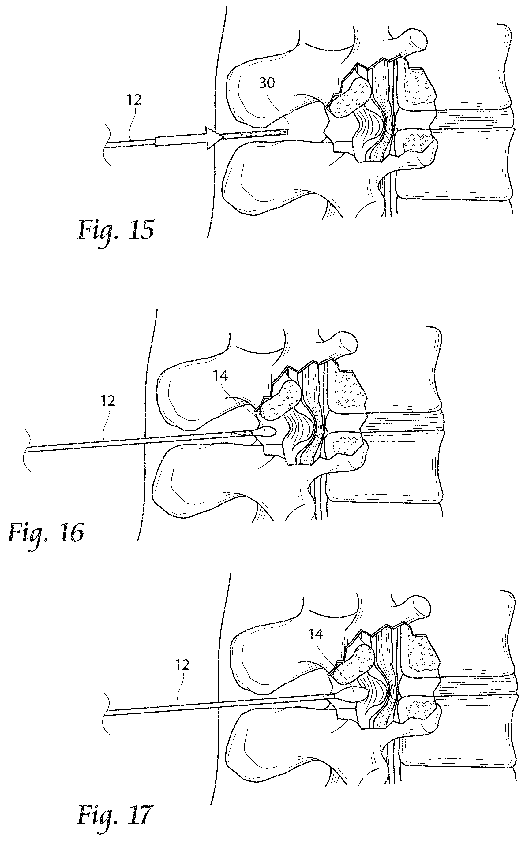 Patent US11779380 Figure 8 – Methods, systems, and devices for the treatment of stenosis