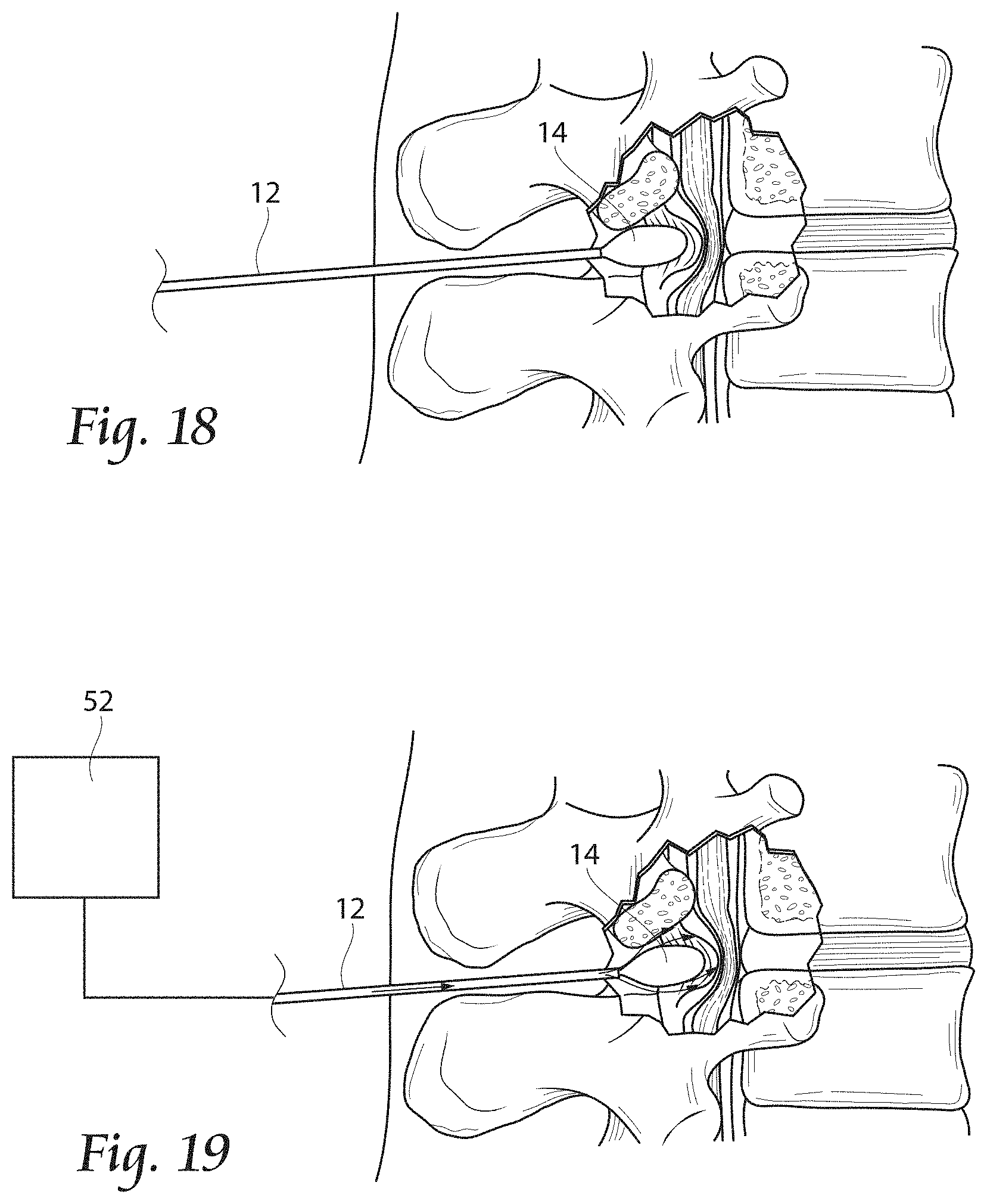 Patent US11779380 Figure 9 – Methods, systems, and devices for the treatment of stenosis