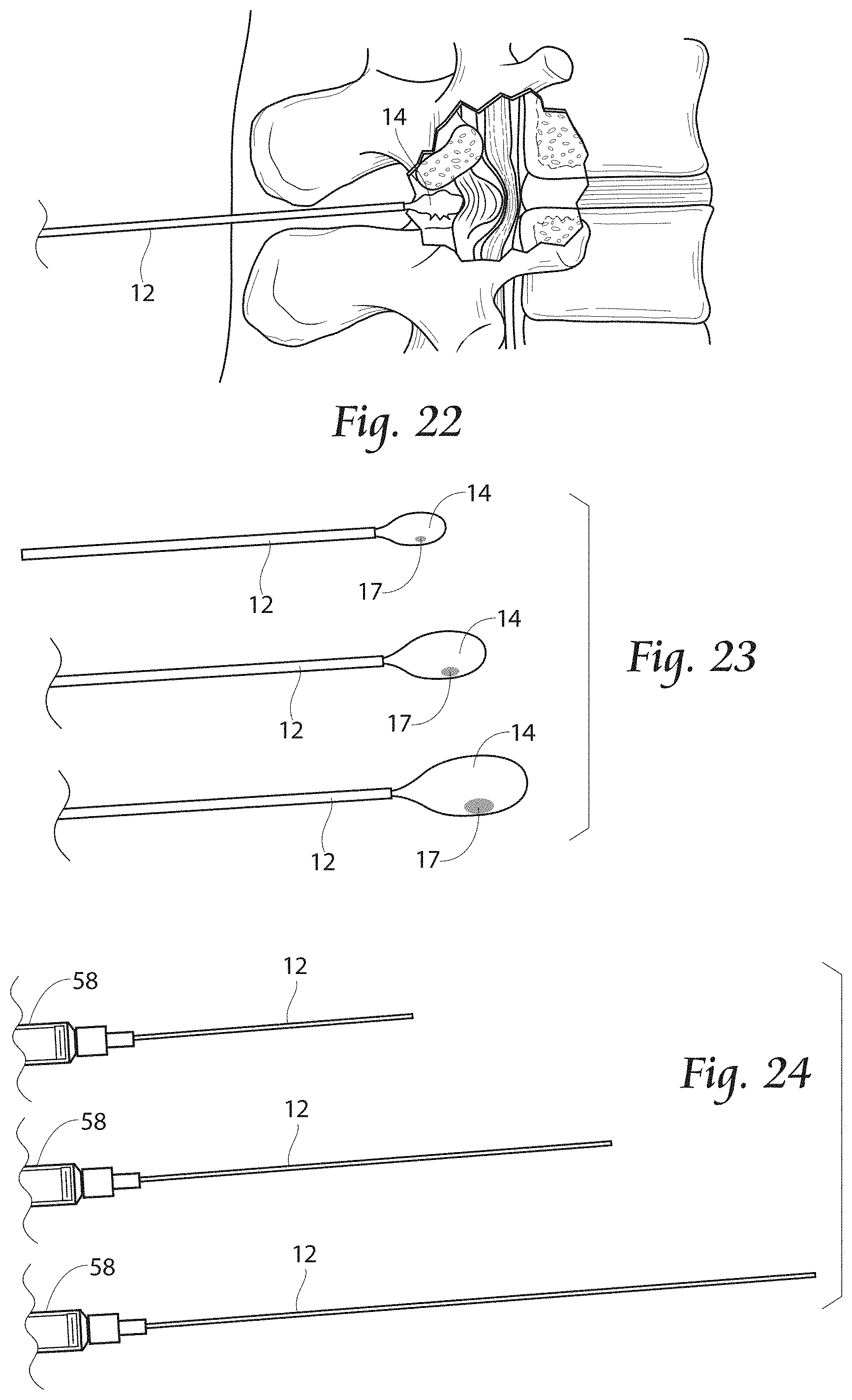 Patent US11779380 Figure 11 – Methods, systems, and devices for the treatment of stenosis