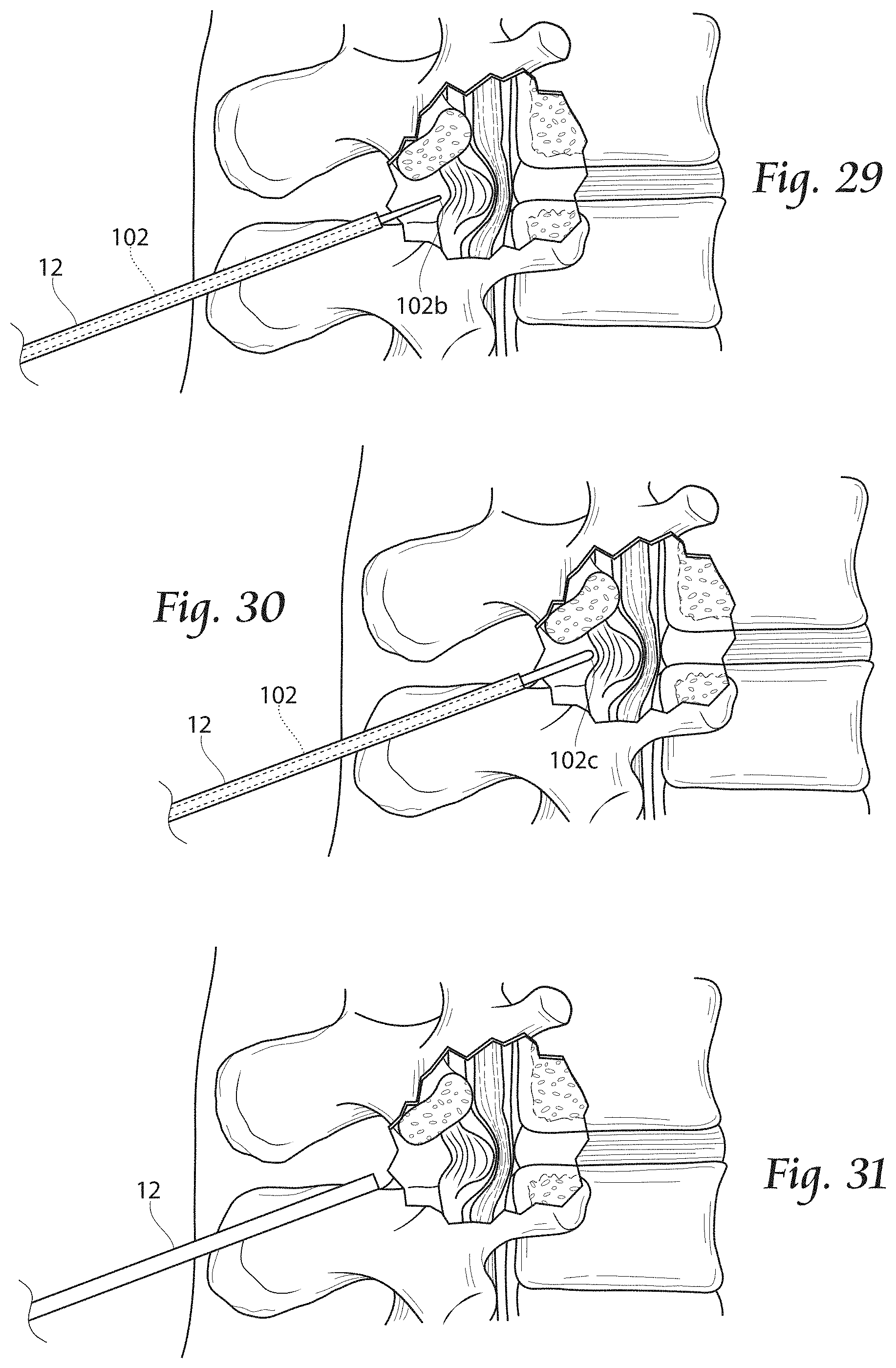 Patent US11779380 Figure 14 – Methods, systems, and devices for the treatment of stenosis