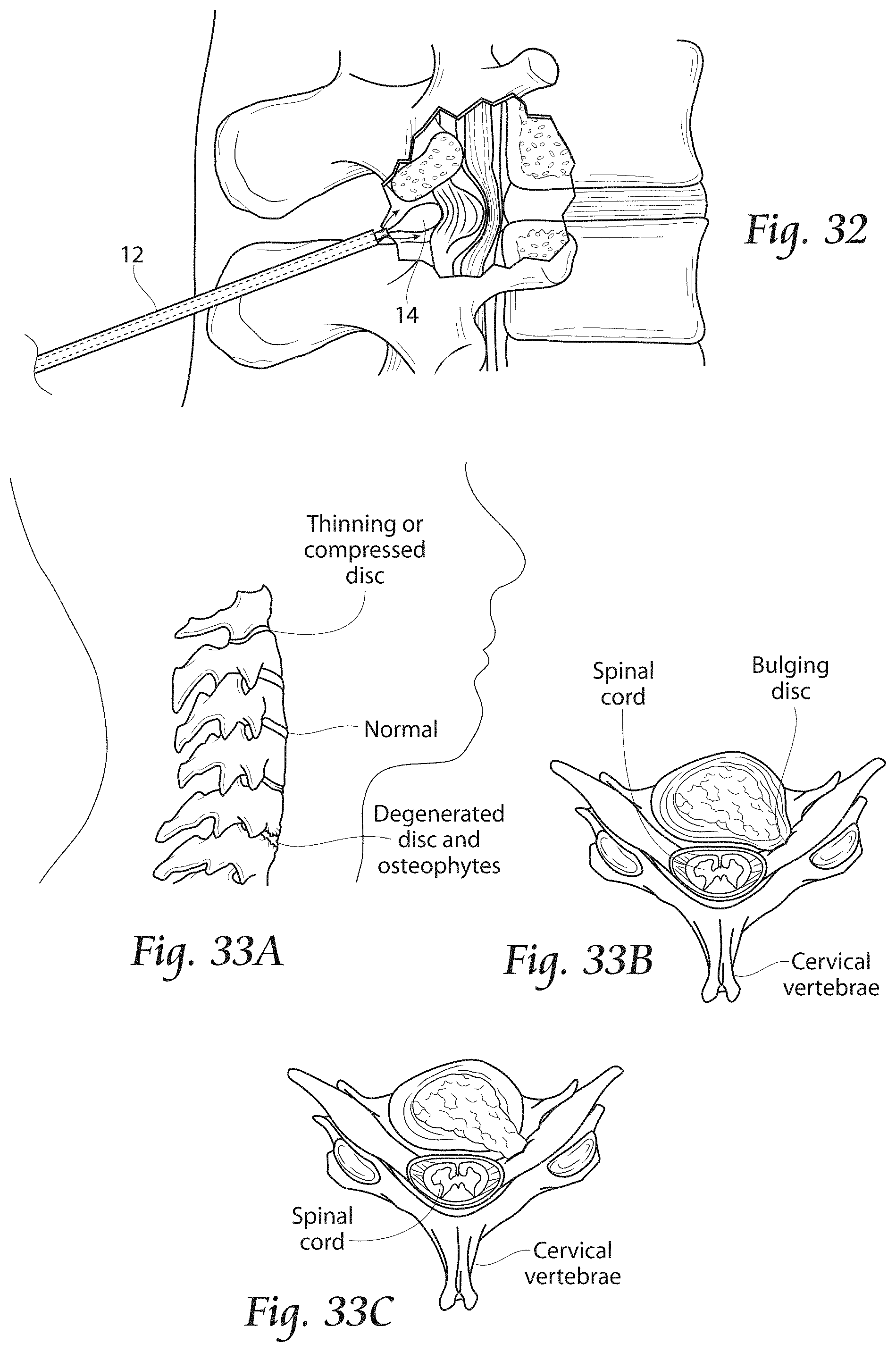 Patent US11779380 Figure 15 – Methods, systems, and devices for the treatment of stenosis