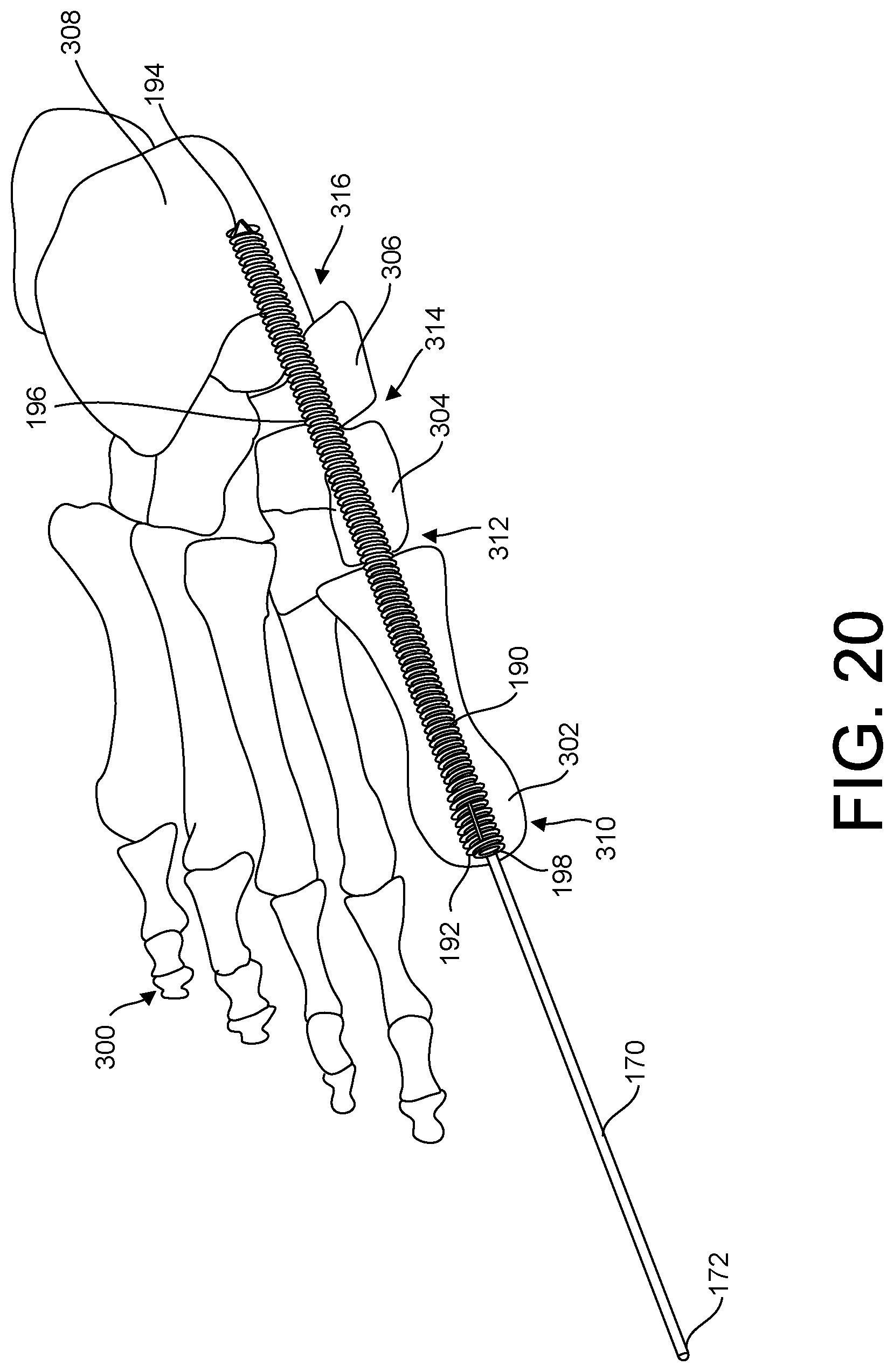 Patent US11779381 Figure 16 – Bone fixation system, assembly, implants, devices, alignment guides, and methods of use
