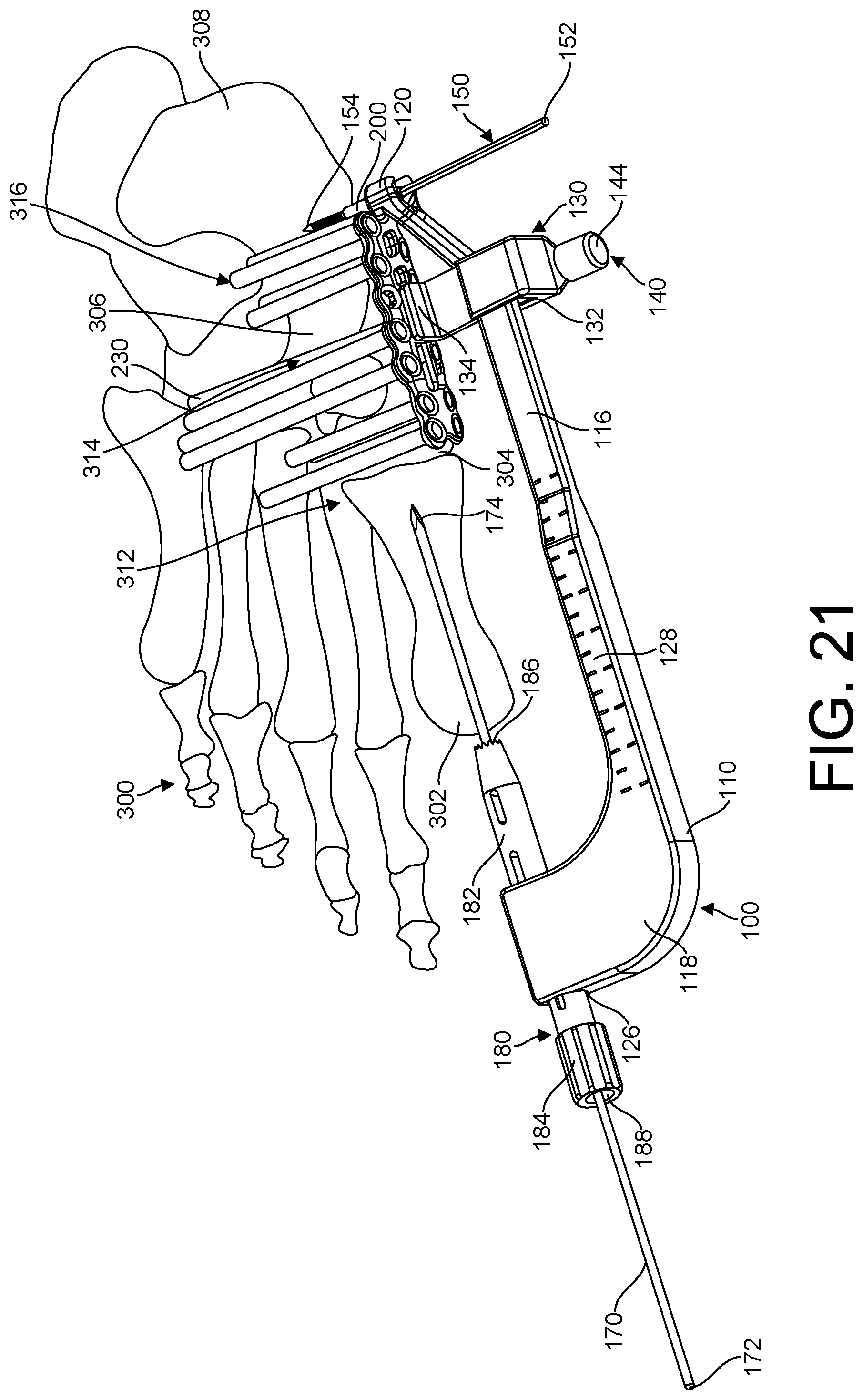 Patent US11779381 Figure 17 – Bone fixation system, assembly, implants, devices, alignment guides, and methods of use