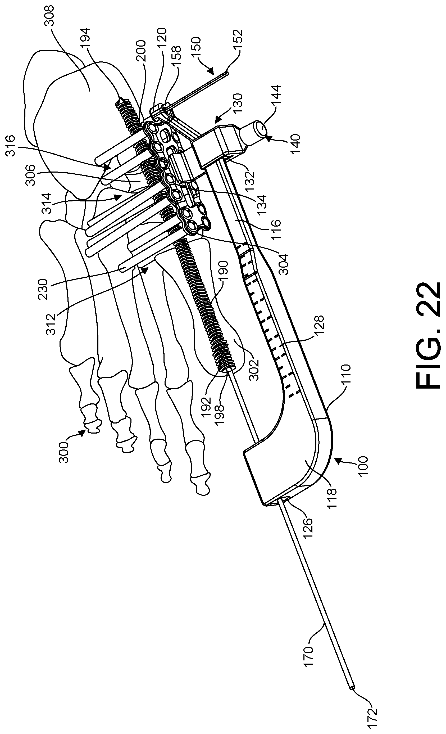 Patent US11779381 Figure 18 – Bone fixation system, assembly, implants, devices, alignment guides, and methods of use