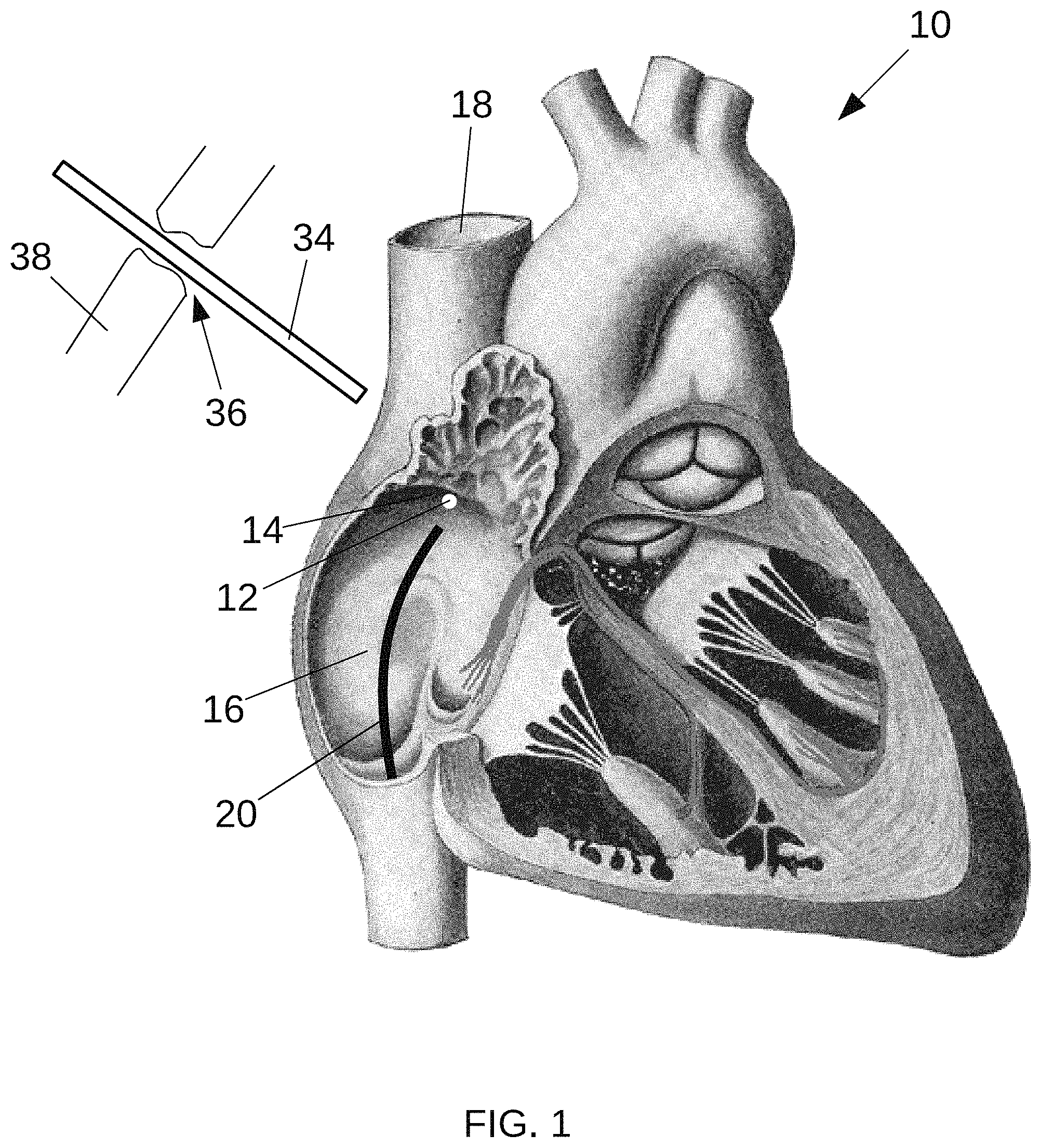 Patent US11779397 Figure 1 – Biological tissue position location and marking