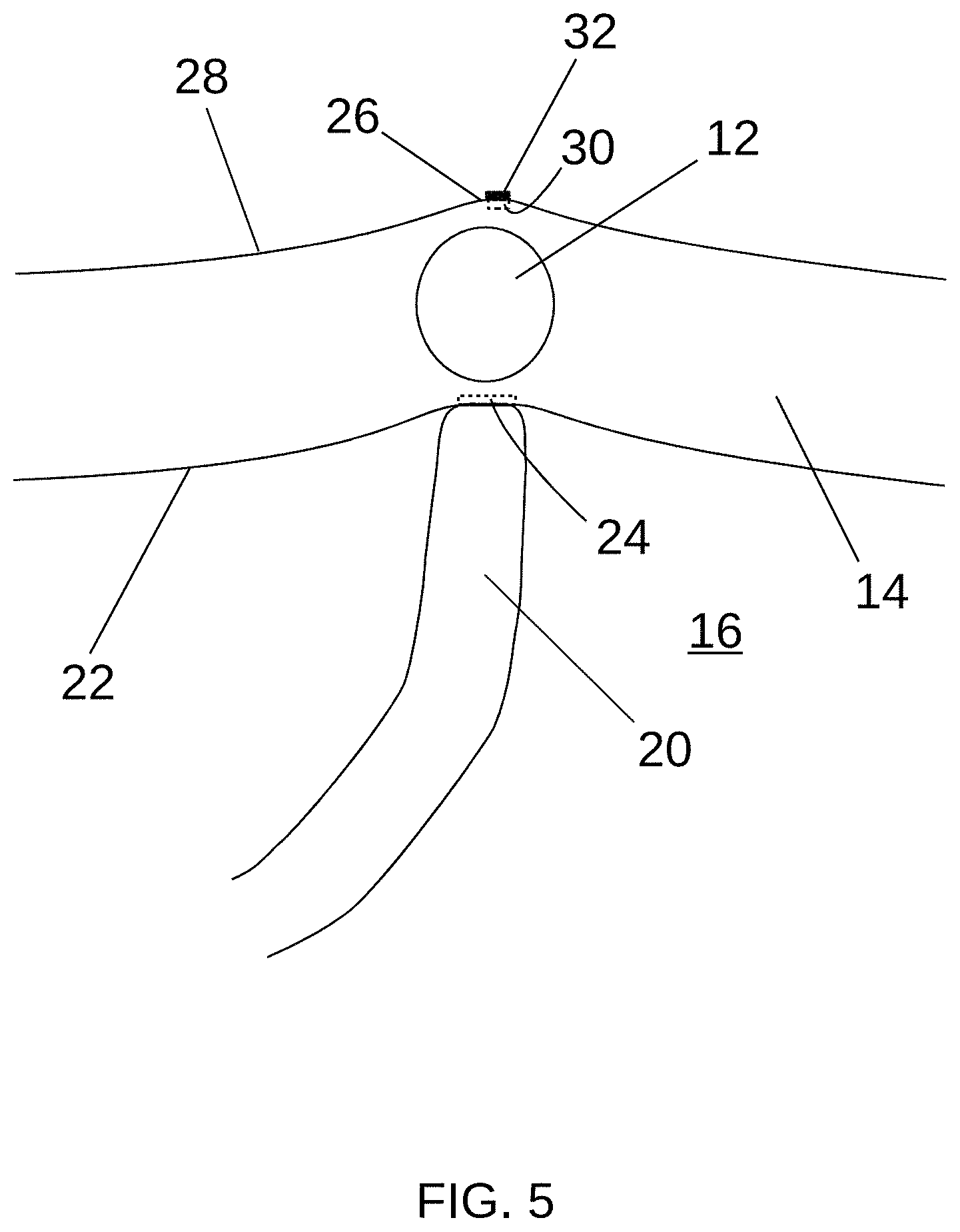 Patent US11779397 Figure 5 – Biological tissue position location and marking