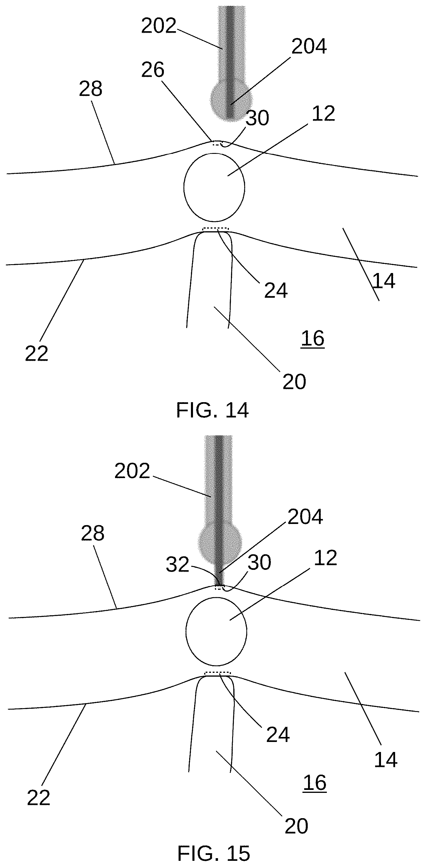 Patent US11779397 Figure 11 – Biological tissue position location and marking