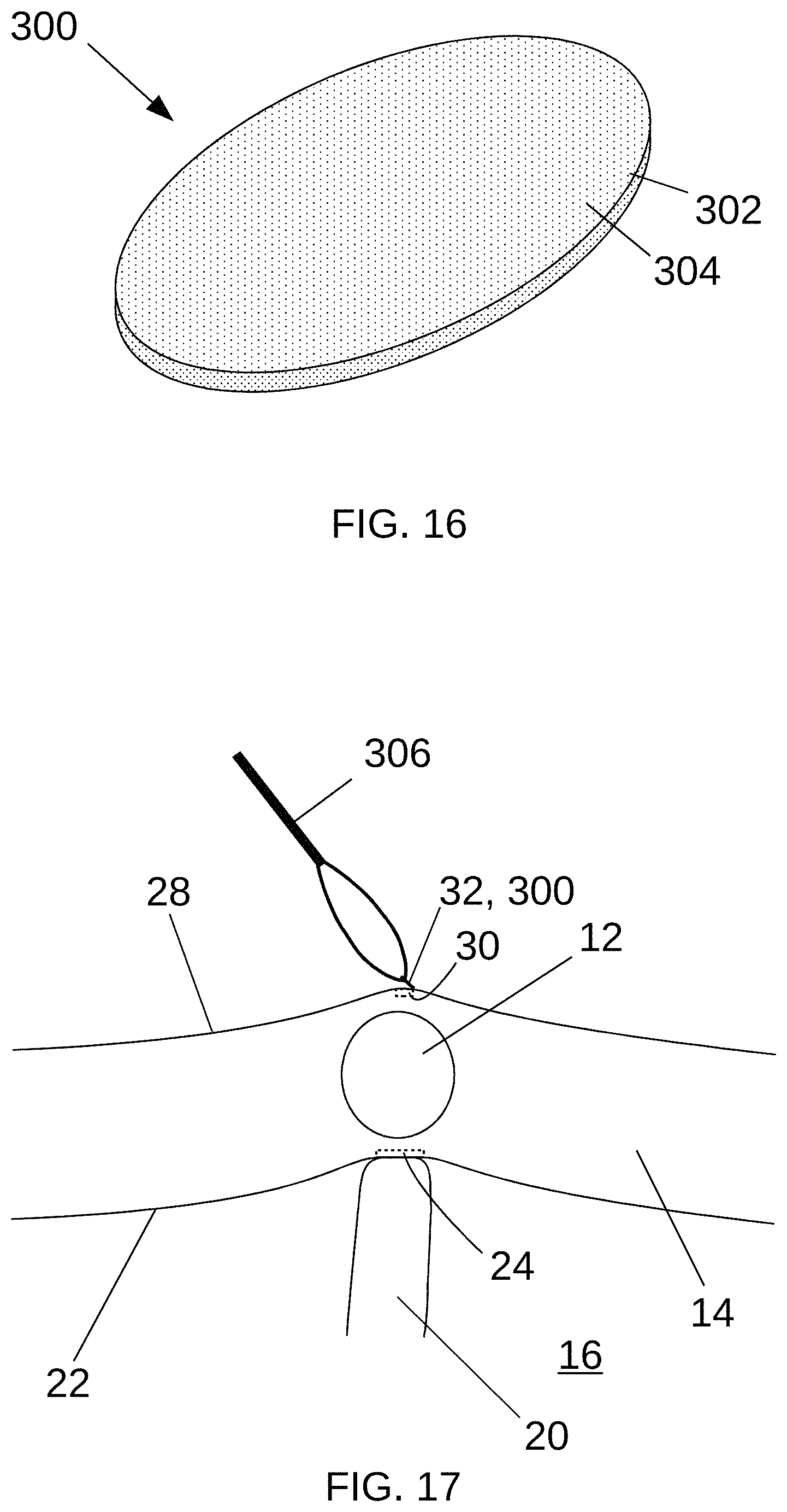 Patent US11779397 Figure 12 – Biological tissue position location and marking