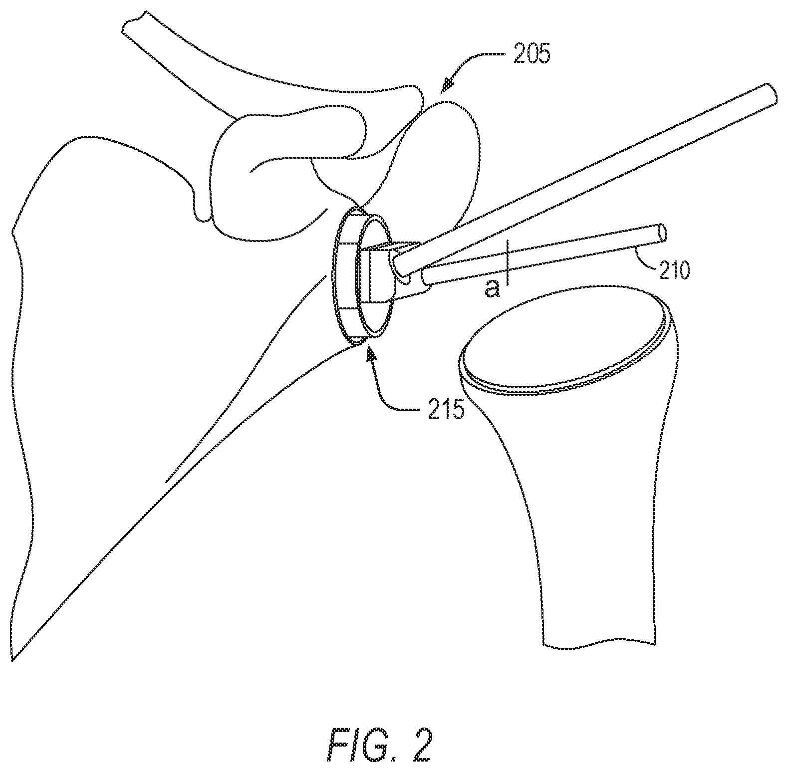 Patent US11779402 Figure 2 – Robotic shoulder repair and reconstruction