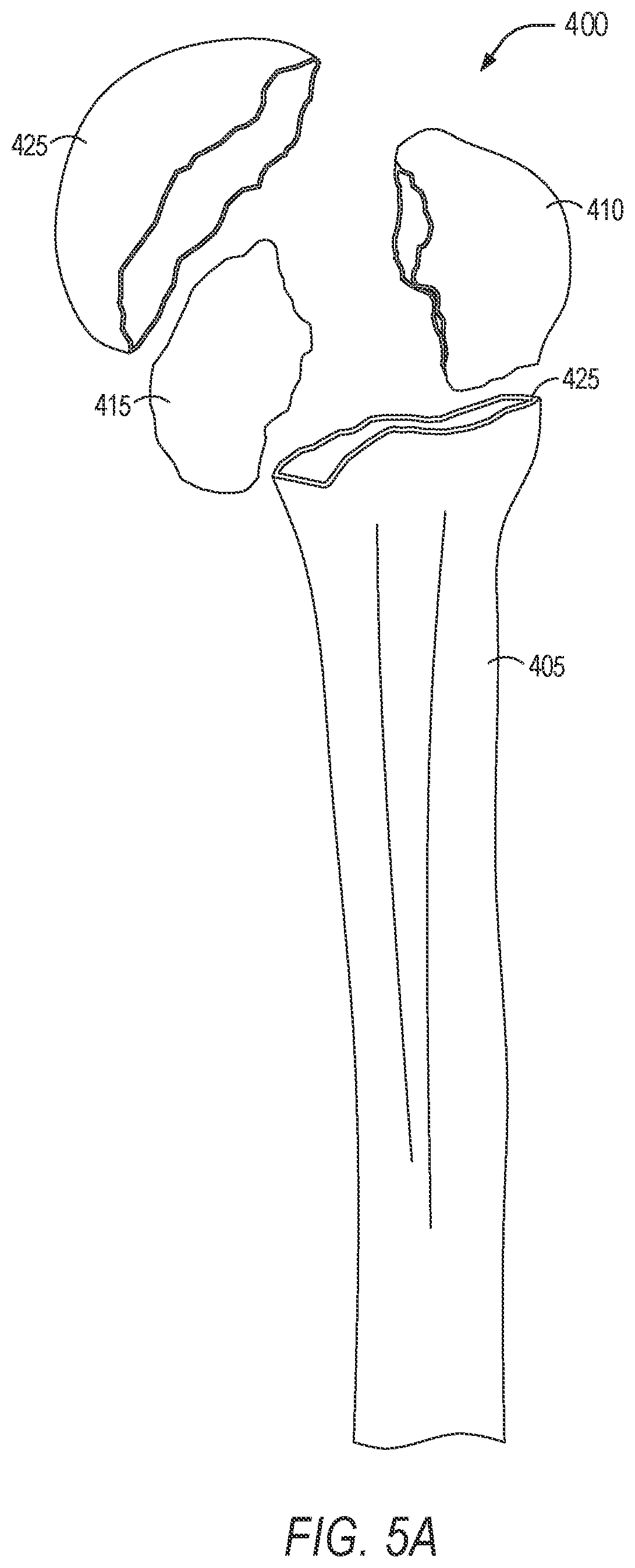 Patent US11779402 Figure 5 – Robotic shoulder repair and reconstruction