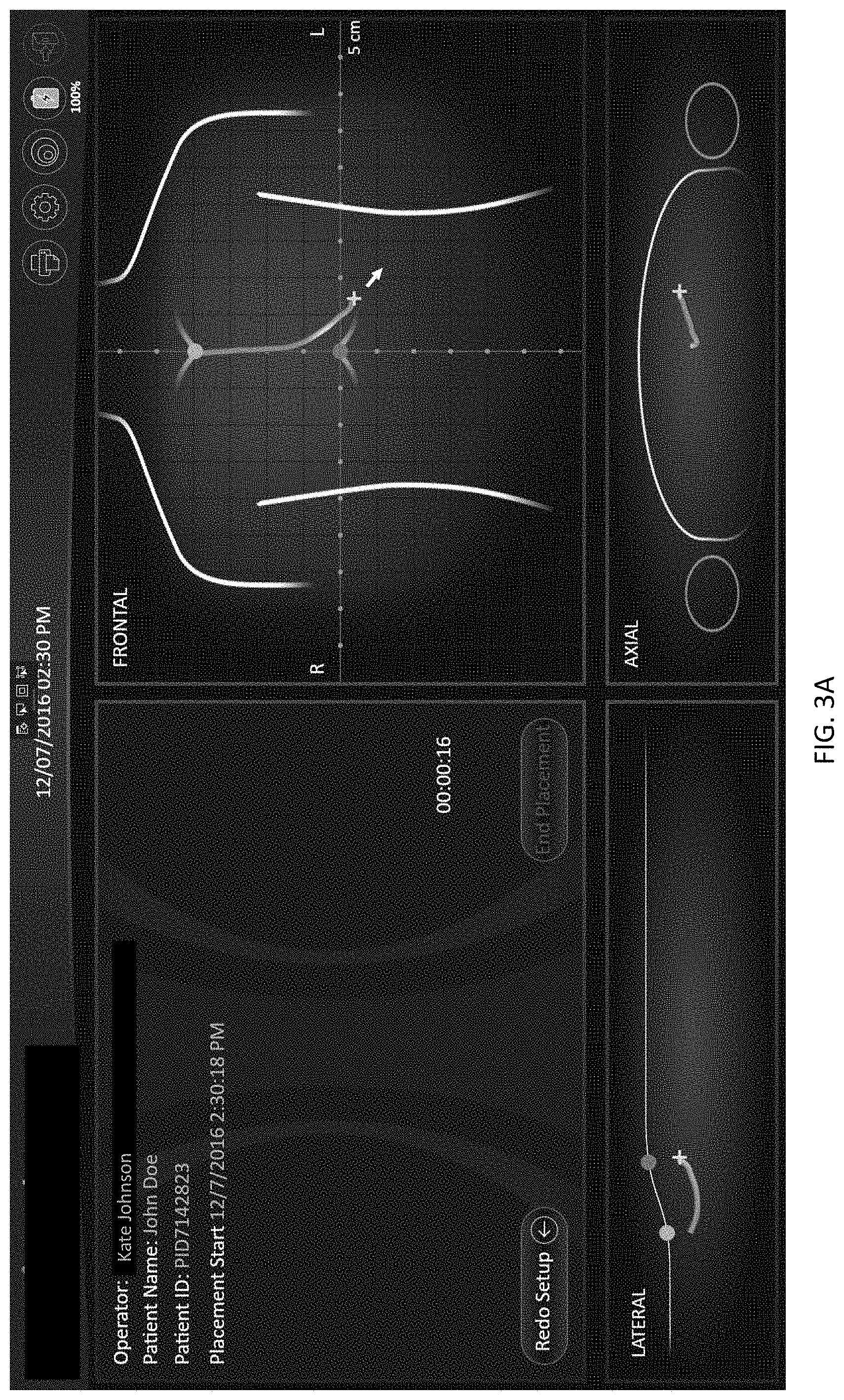 Patent US11779403 Figure 7 – Insertion device positioning guidance system and method