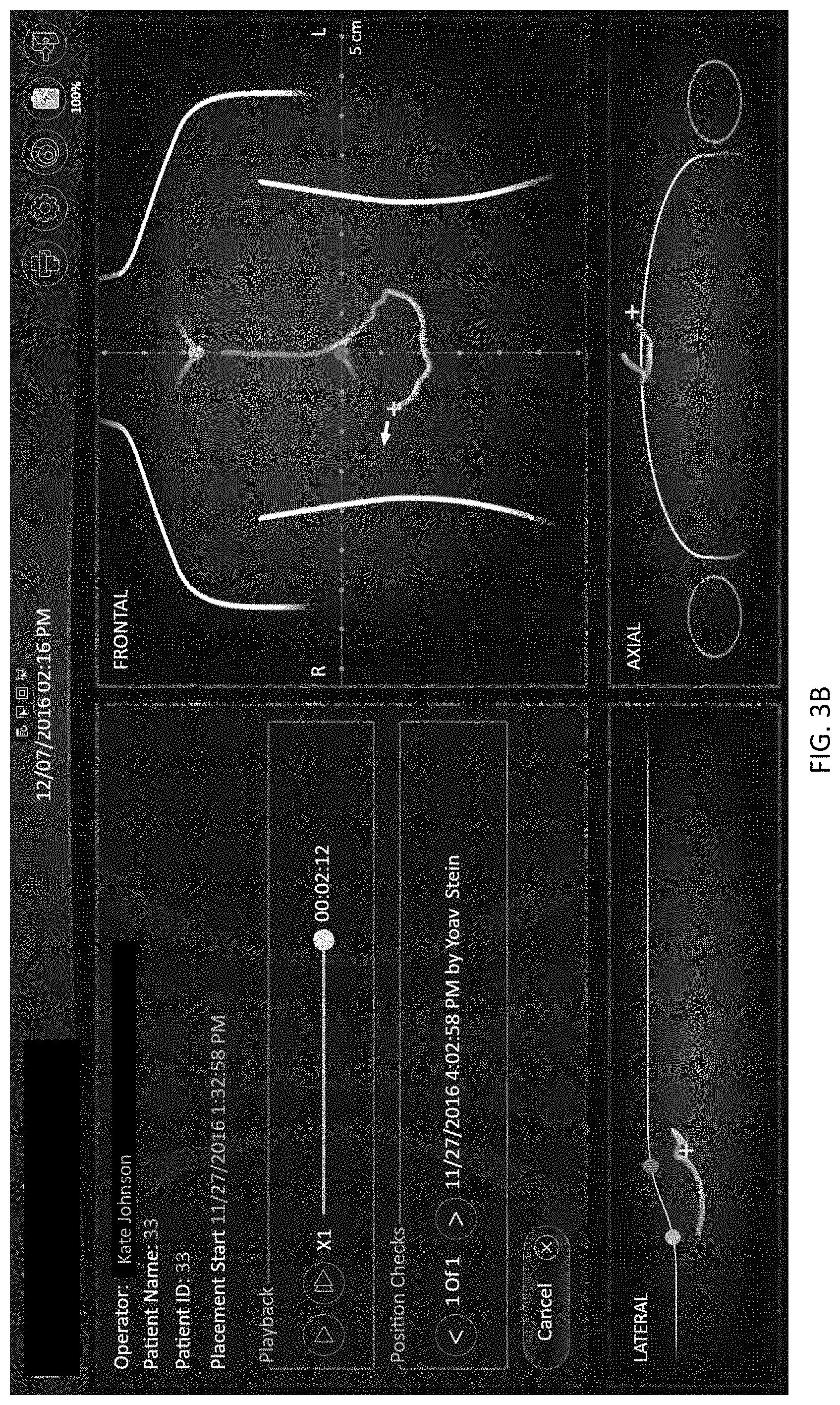 Patent US11779403 Figure 8 – Insertion device positioning guidance system and method