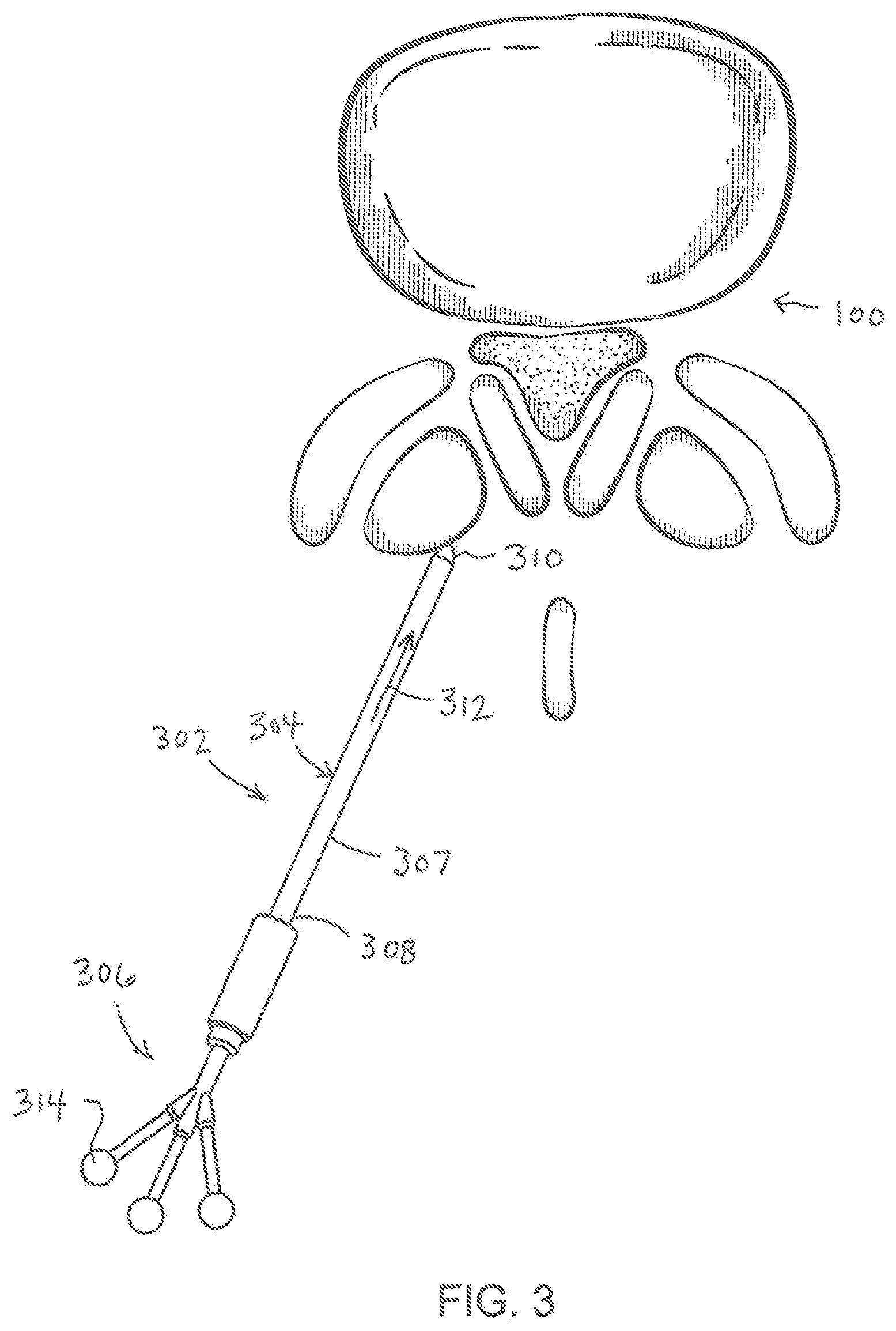 Patent US11779404 Figure 3 – Instrumentation and surgical method for image-guided microendoscopic decompression