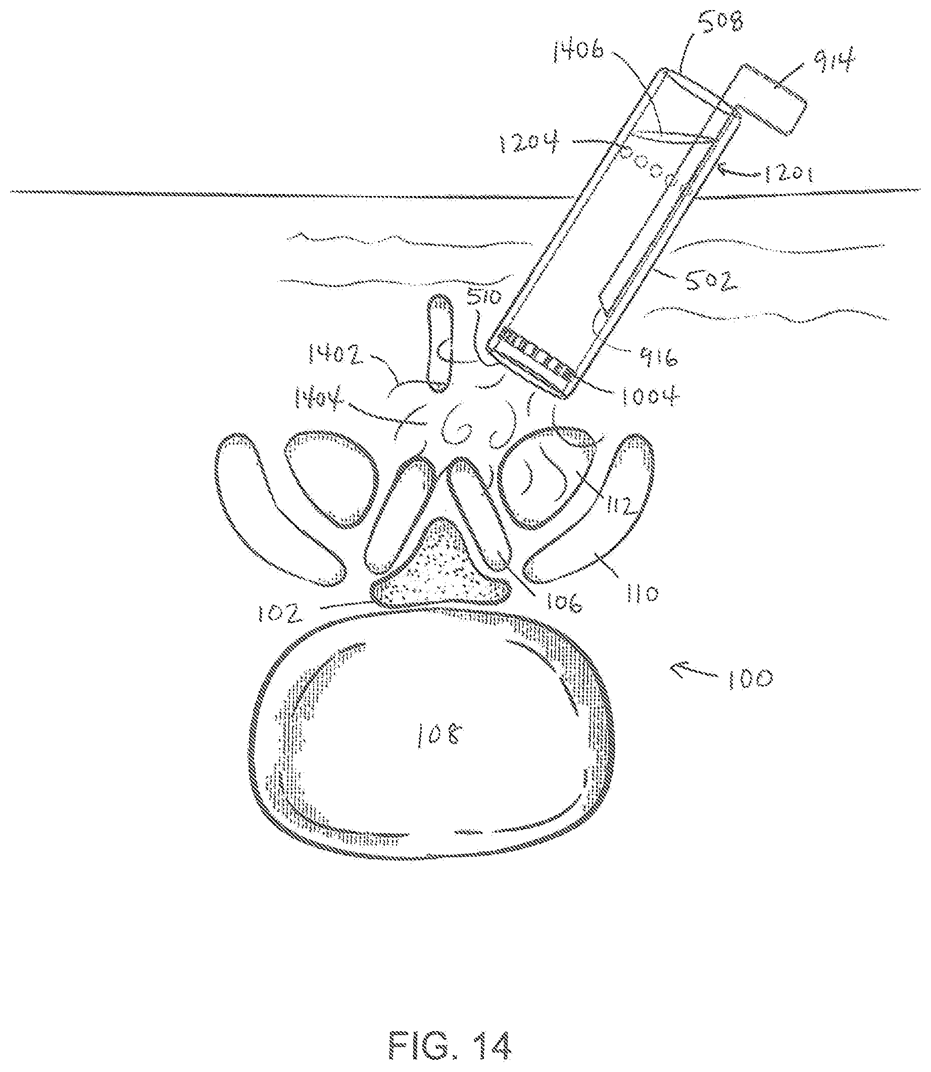 Patent US11779404 Figure 14 – Instrumentation and surgical method for image-guided microendoscopic decompression